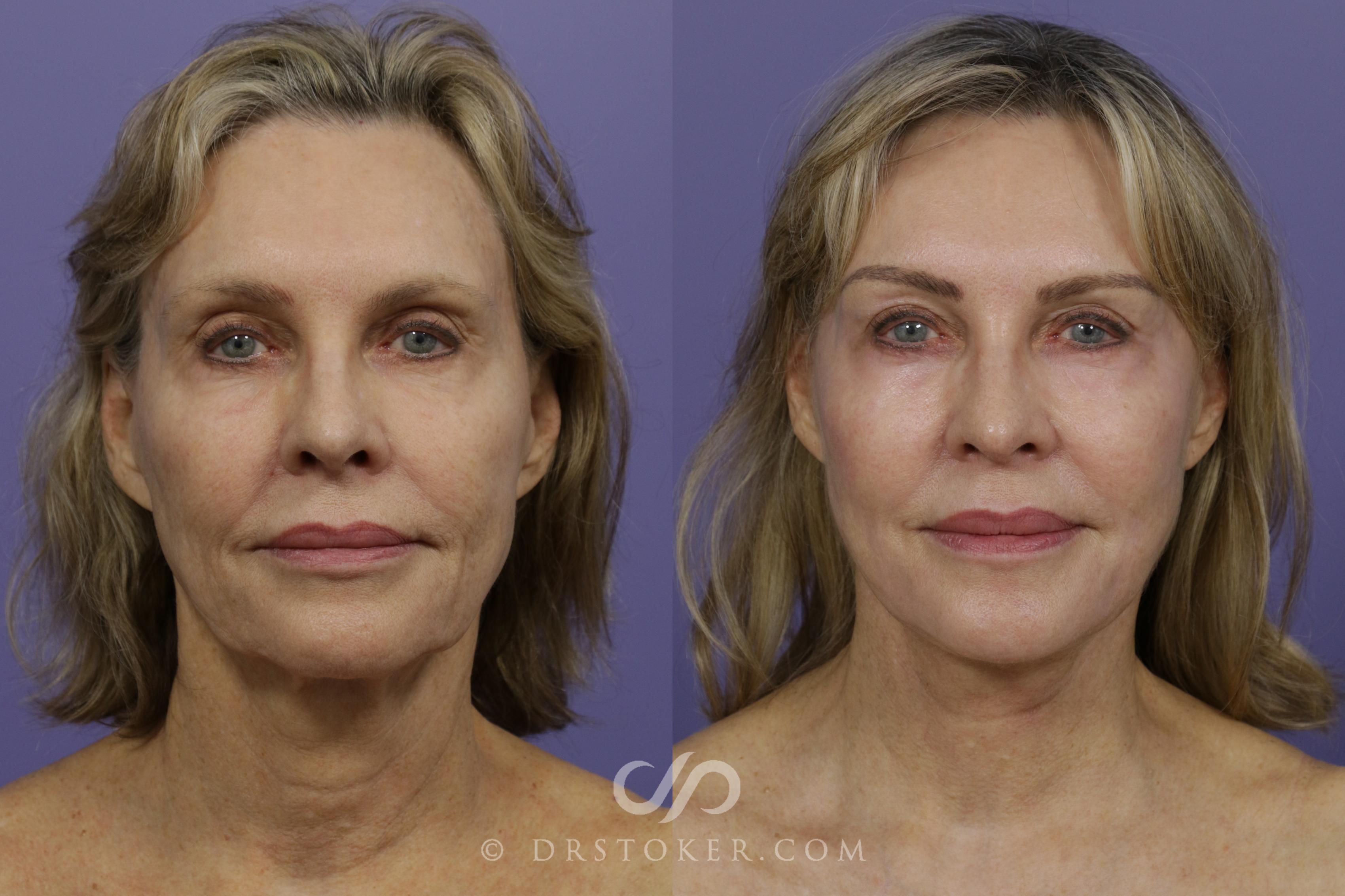 Before & After Facelift - Traceless Facelift Case 1427 View #1 View in Los Angeles, CA