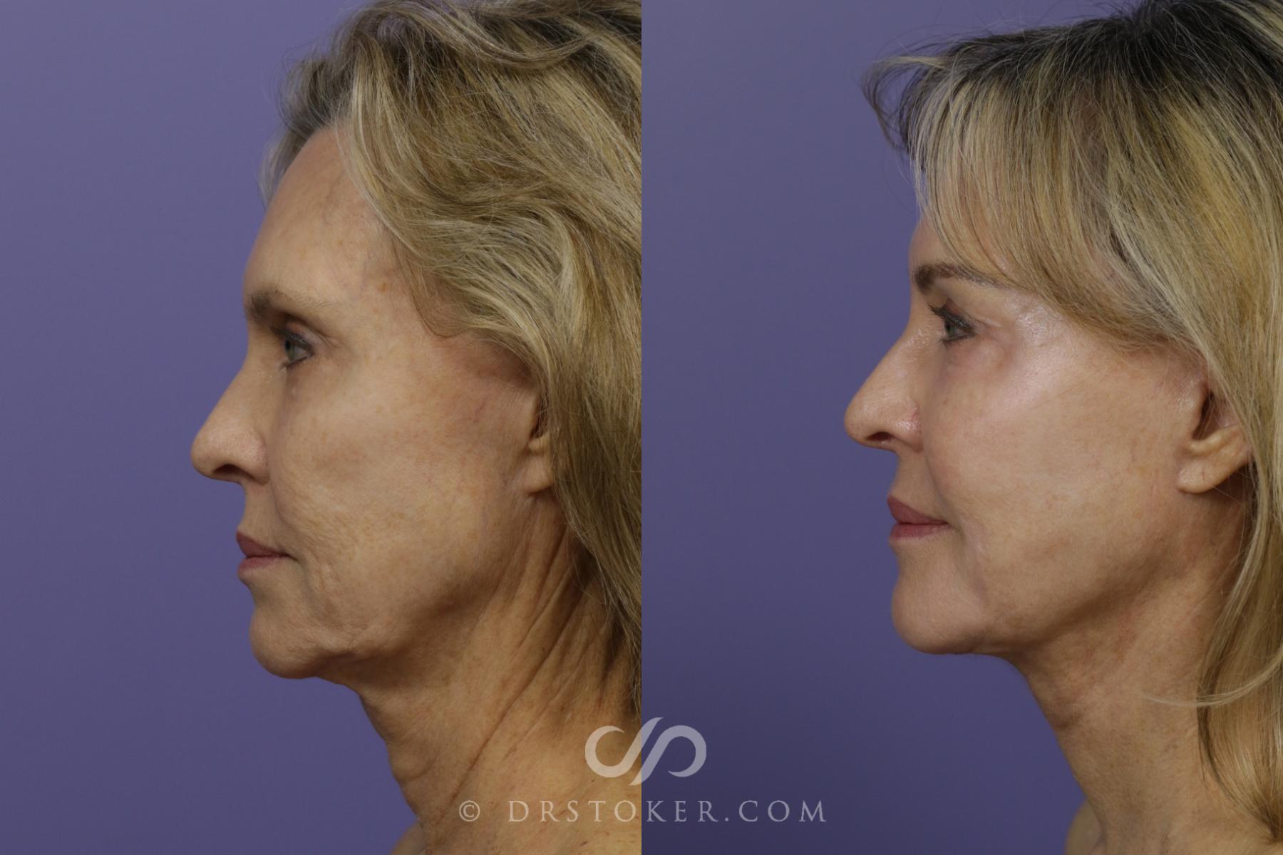 Before & After Facelift - Traceless Facelift Case 1427 View #2 View in Los Angeles, CA