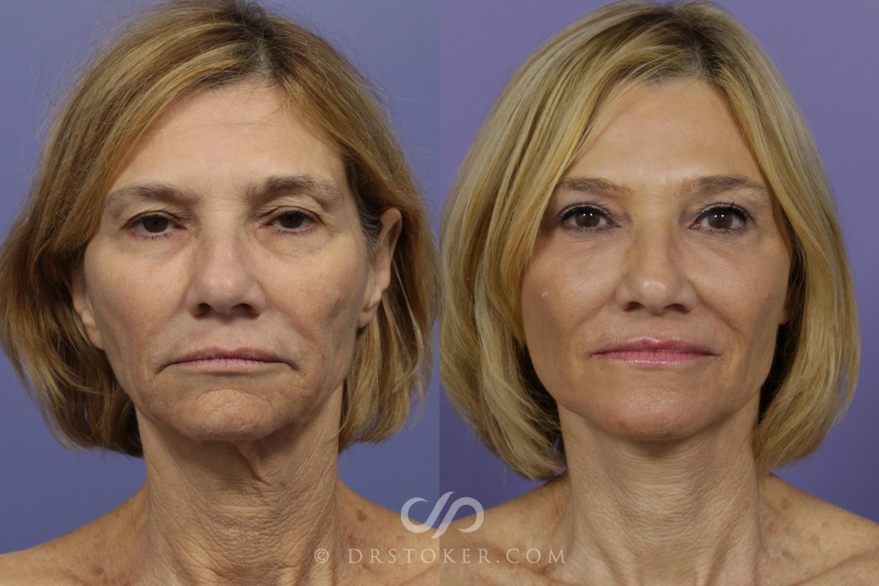 Before & After Laser Skin Resurfacing Case 1428 View #1 View in Los Angeles, CA