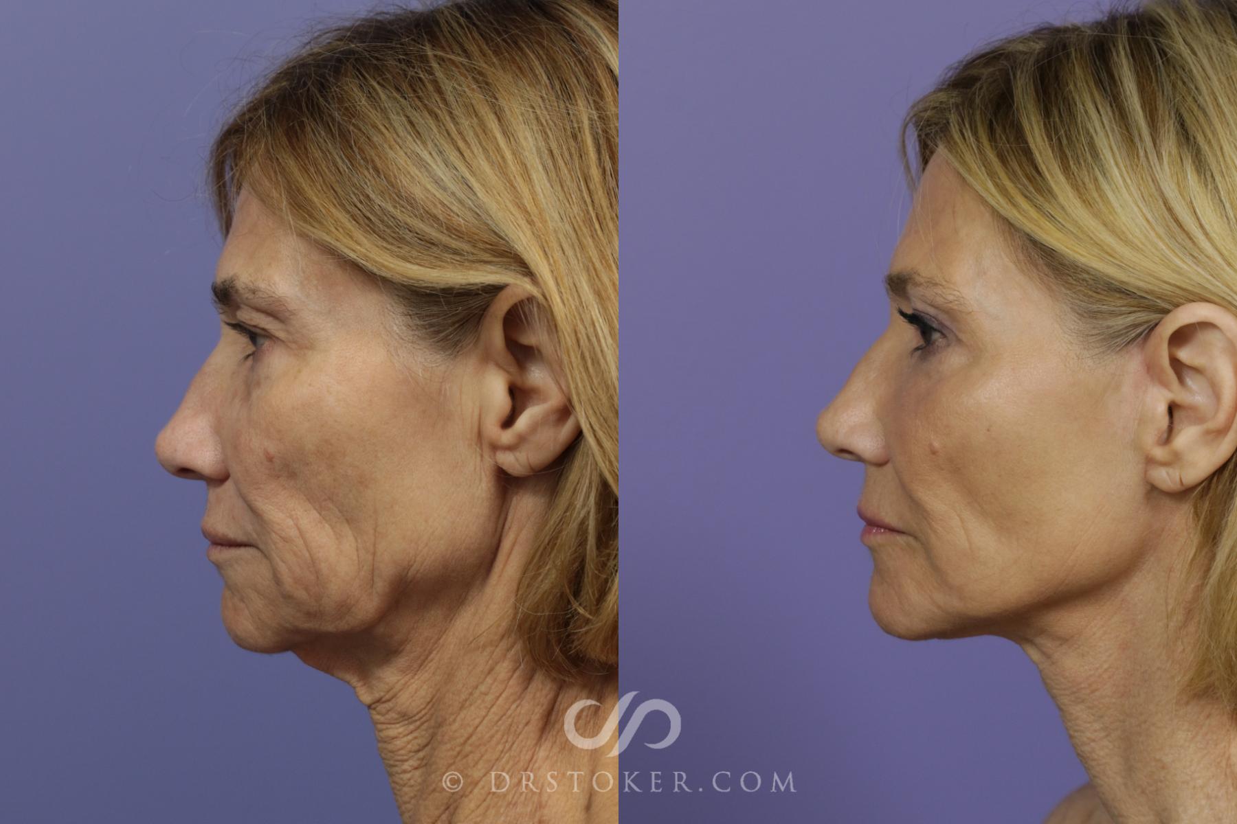 Before & After Neck Lift - Traceless Neck Lift  Case 1428 View #5 View in Los Angeles, CA