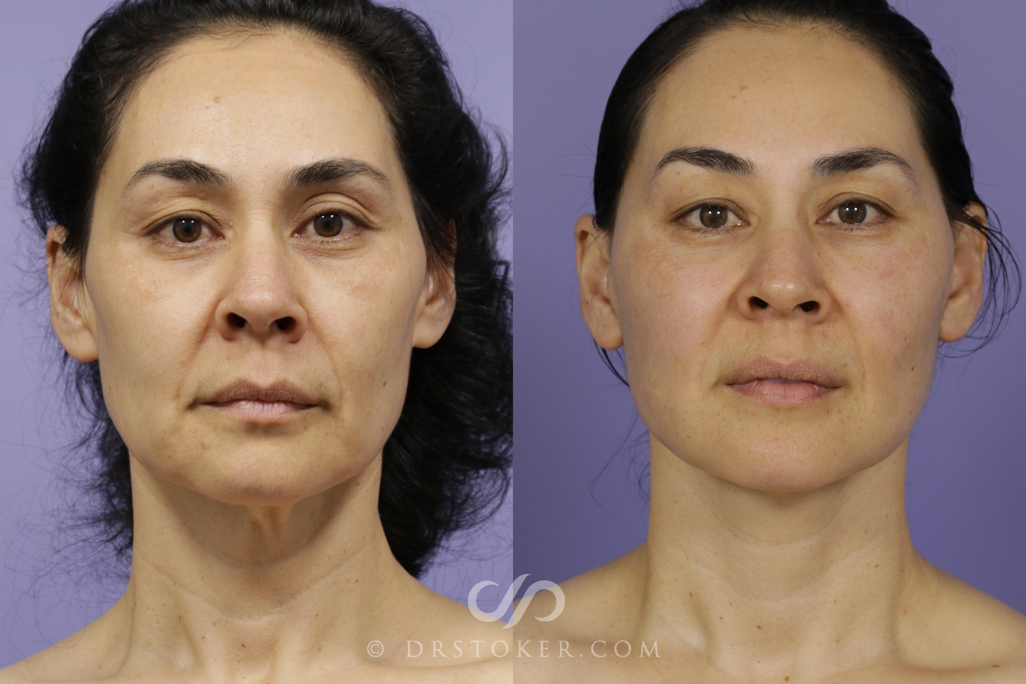 Before & After Facelift - Traceless Facelift Case 1429 View #1 View in Los Angeles, CA