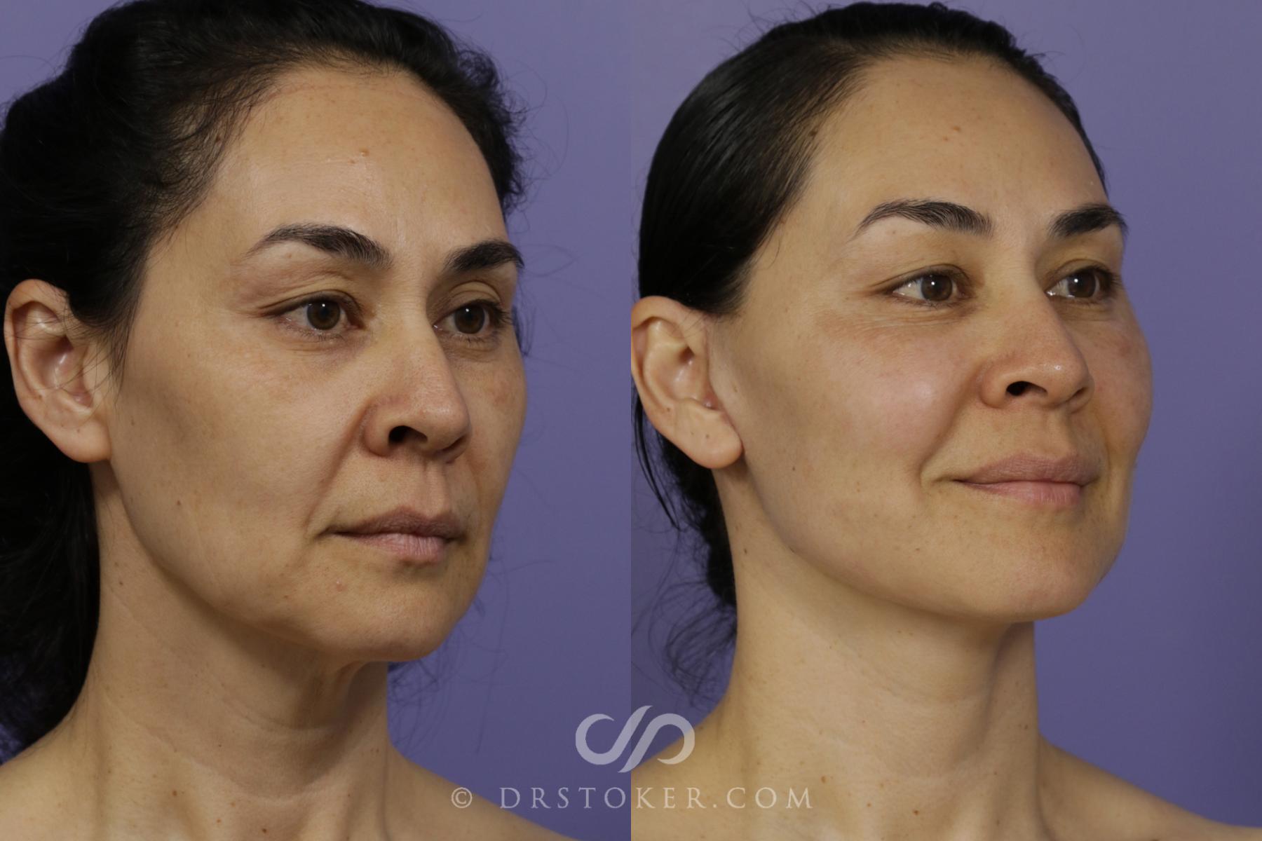 Before & After Facelift - Traceless Facelift Case 1429 View #2 View in Los Angeles, CA