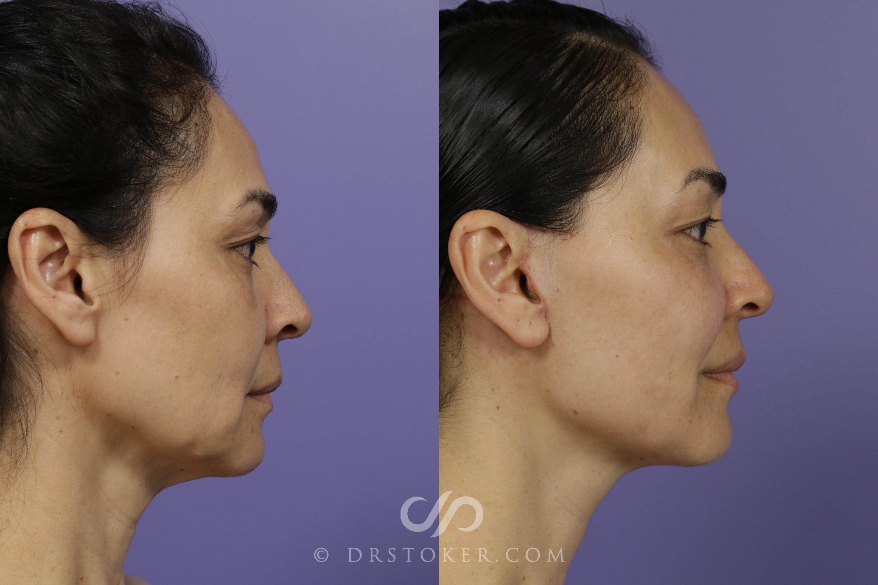 Before & After Facelift - Traceless Facelift Case 1429 View #3 View in Los Angeles, CA