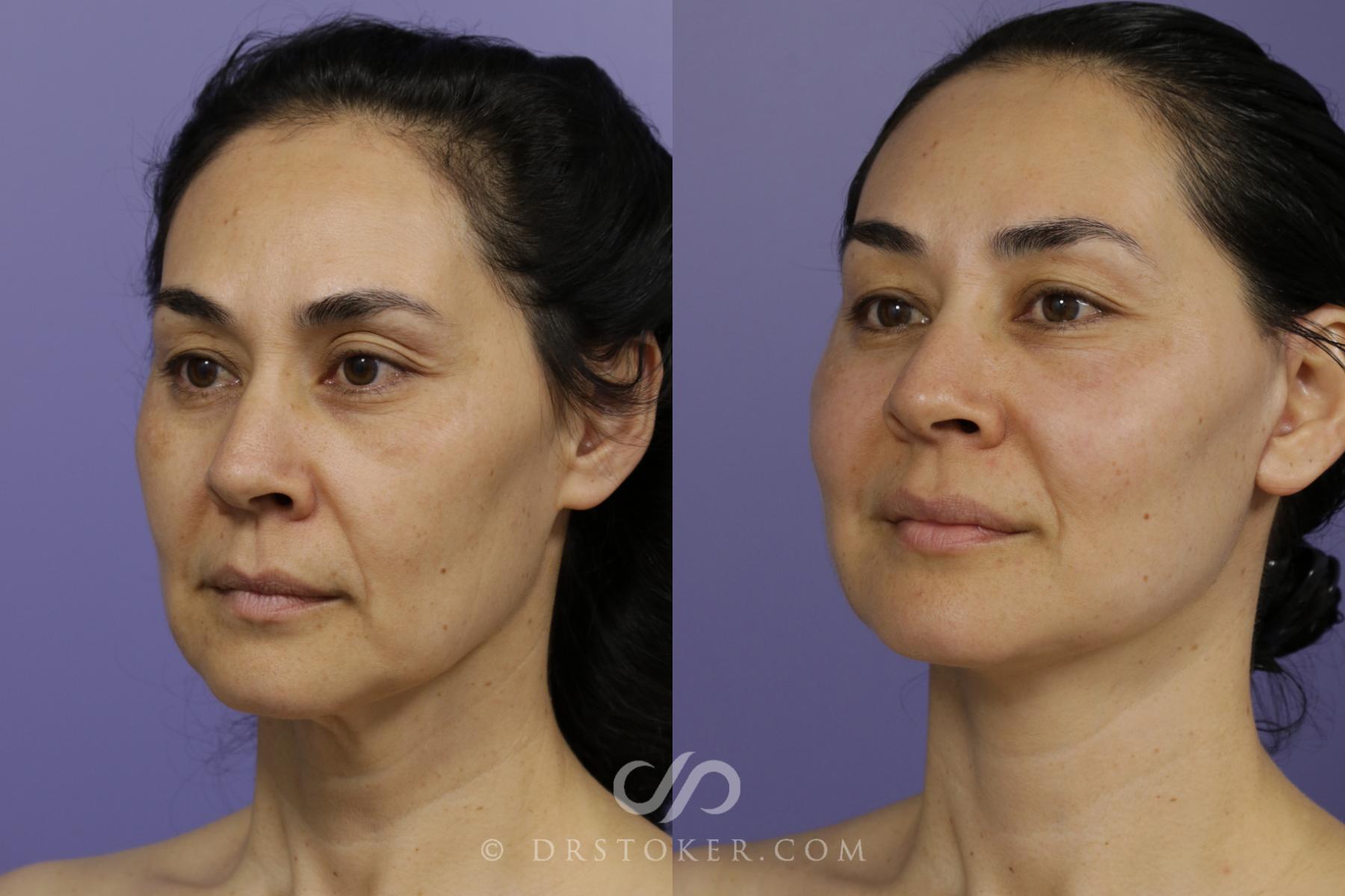 Before & After Neck Lift - Traceless Neck Lift  Case 1429 View #4 View in Los Angeles, CA