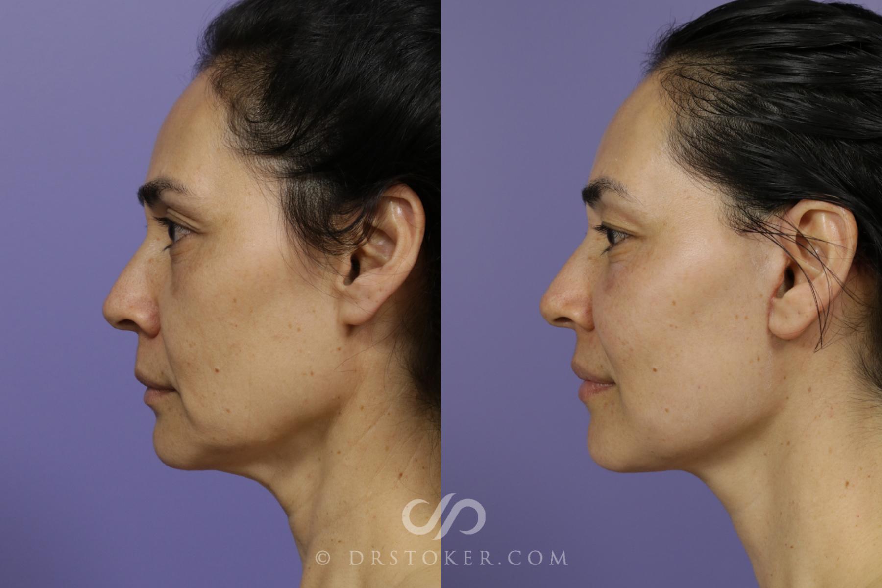 Before & After Neck Lift - Traceless Neck Lift  Case 1429 View #5 View in Los Angeles, CA