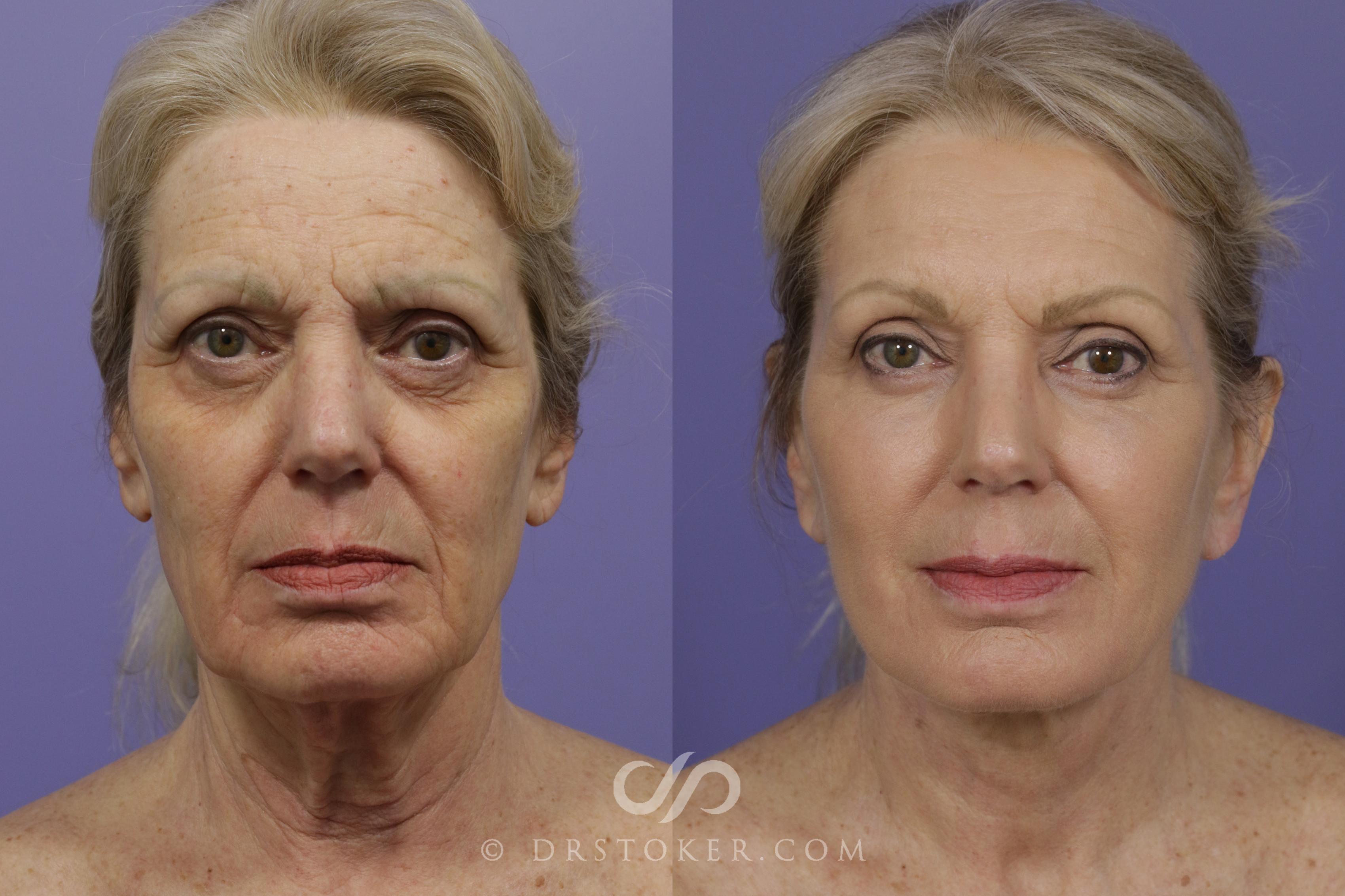 Before & After Facelift - Traceless Facelift Case 1431 View #1 View in Los Angeles, CA