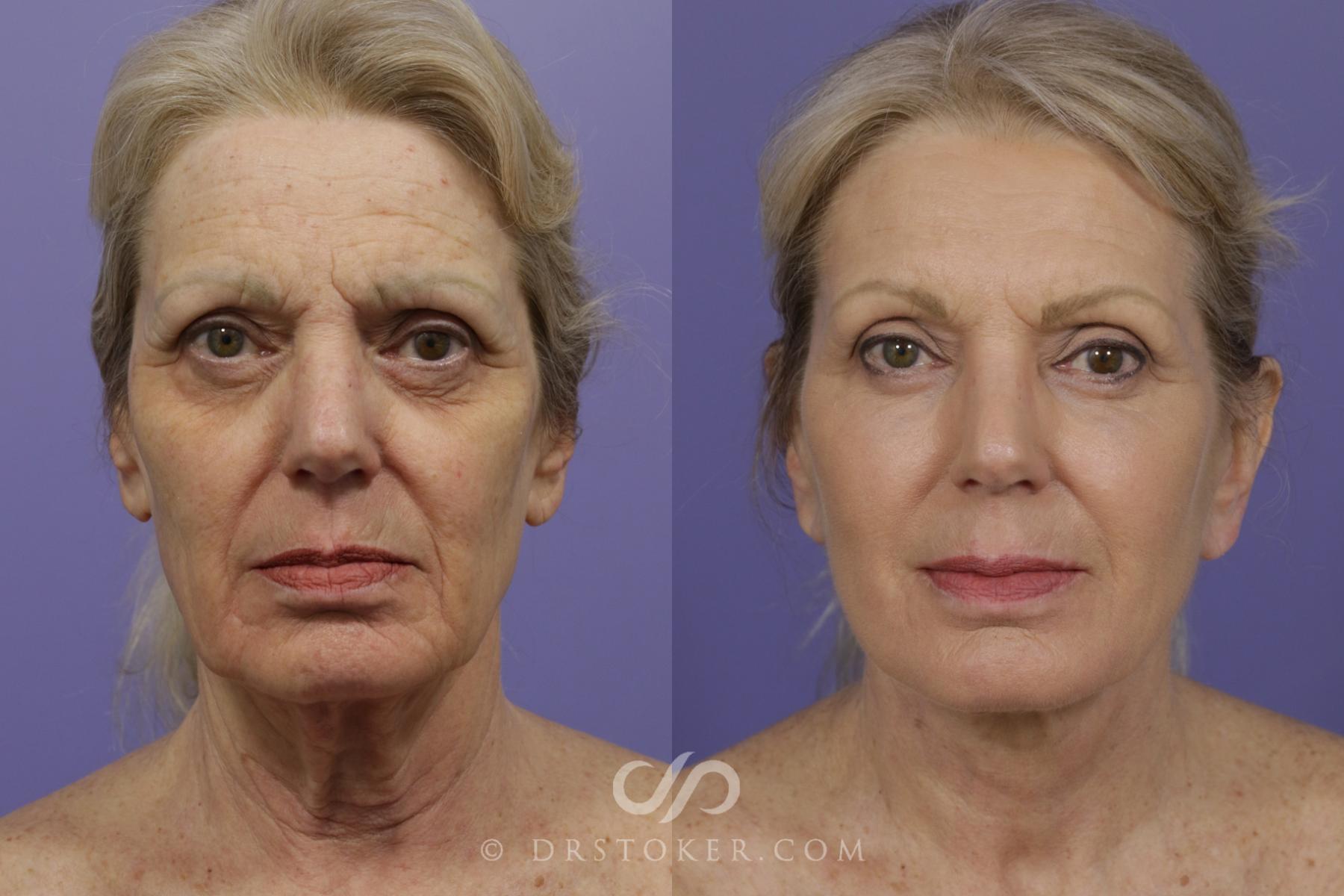 Before & After Laser Skin Resurfacing Case 1431 View #1 View in Los Angeles, CA