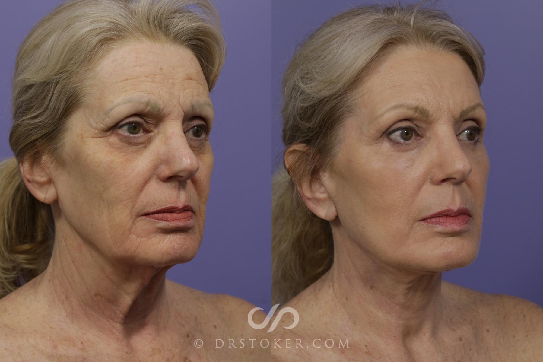 Before & After Neck Lift - Traceless Neck Lift  Case 1431 View #2 View in Los Angeles, CA