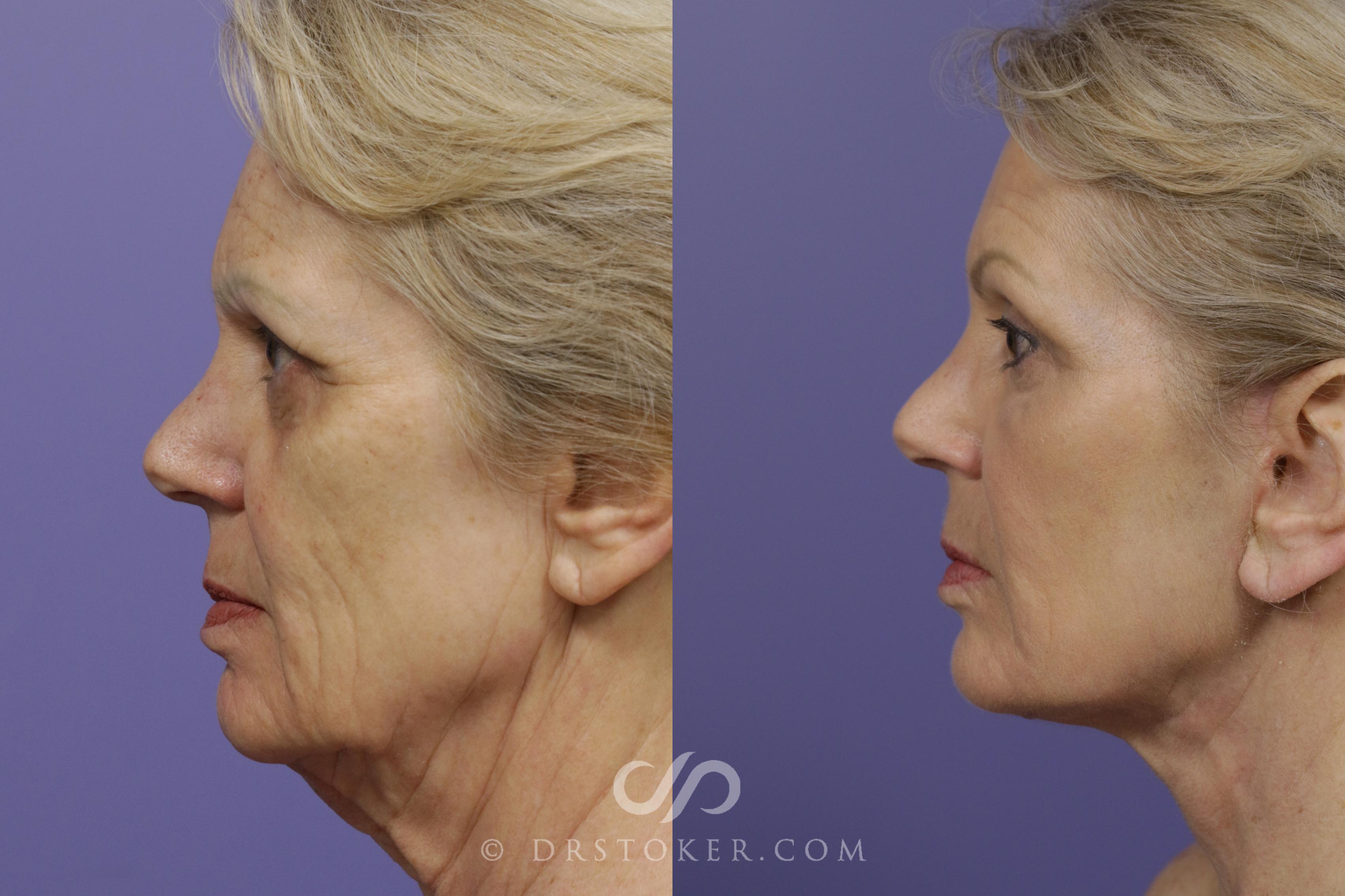 Before & After Facelift - Traceless Facelift Case 1431 View #3 View in Los Angeles, CA