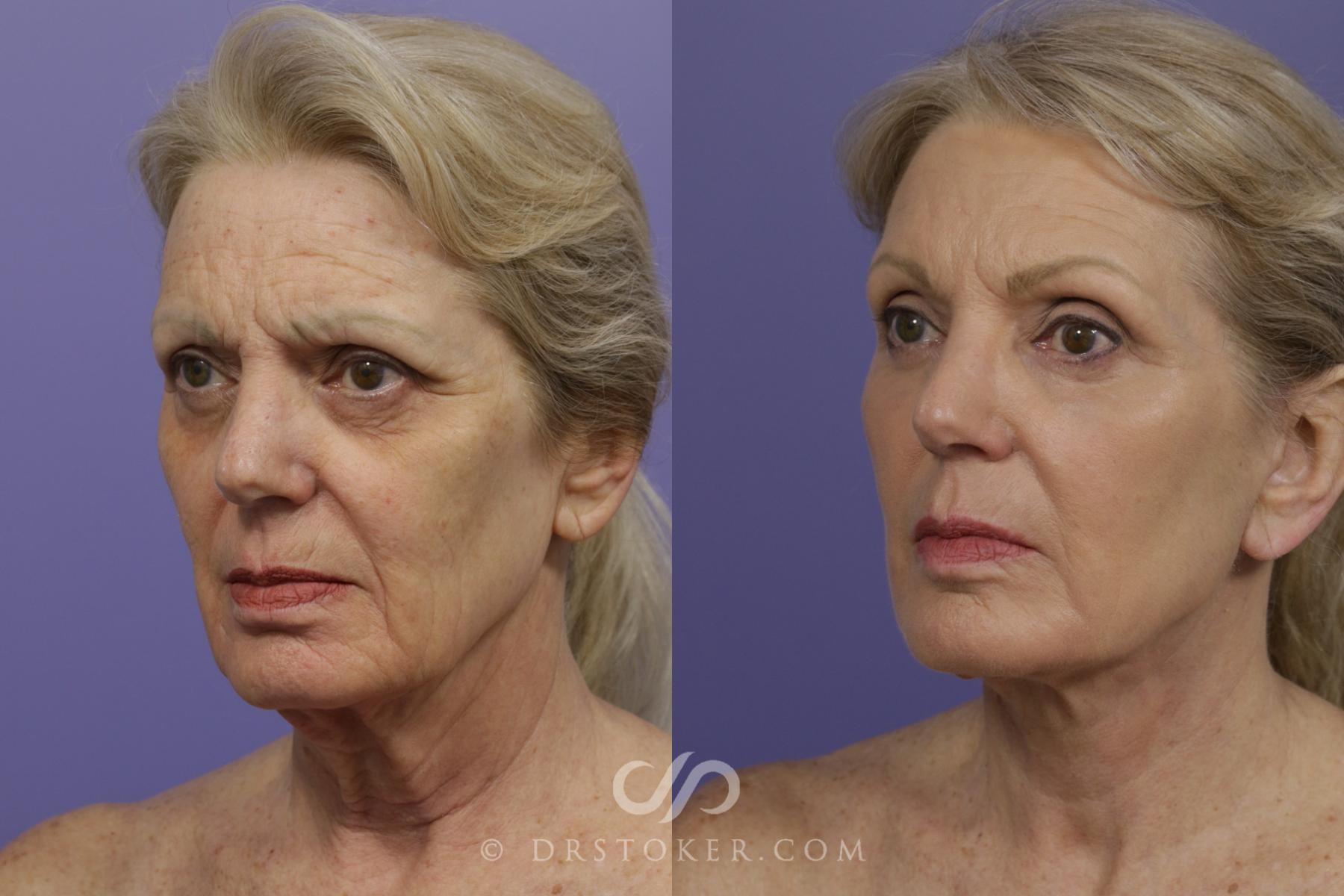 Before & After Facelift - Traceless Facelift Case 1431 View #5 View in Los Angeles, CA