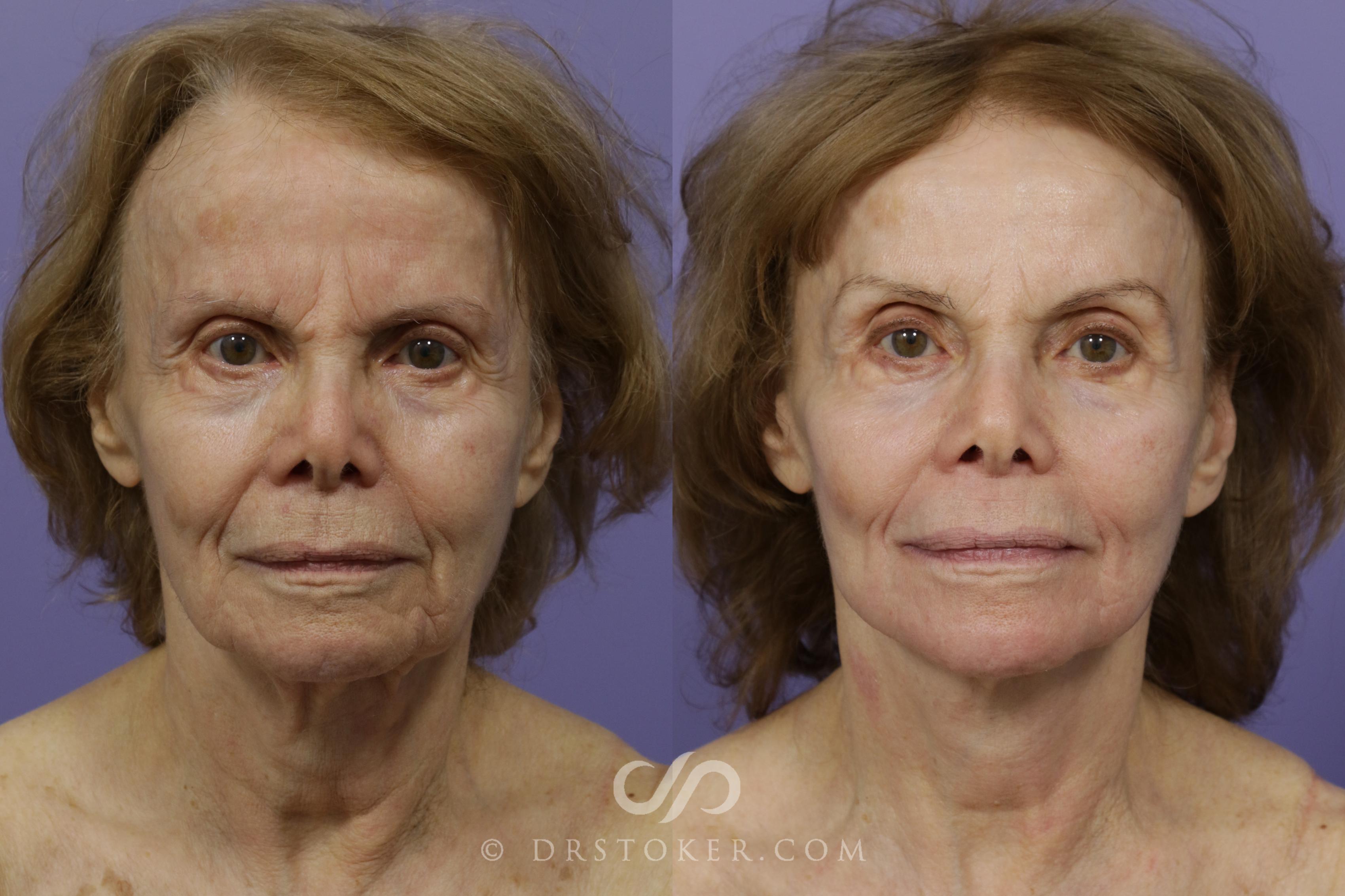 Before & After Facelift - Traceless Facelift Case 1441 View #1 View in Los Angeles, CA