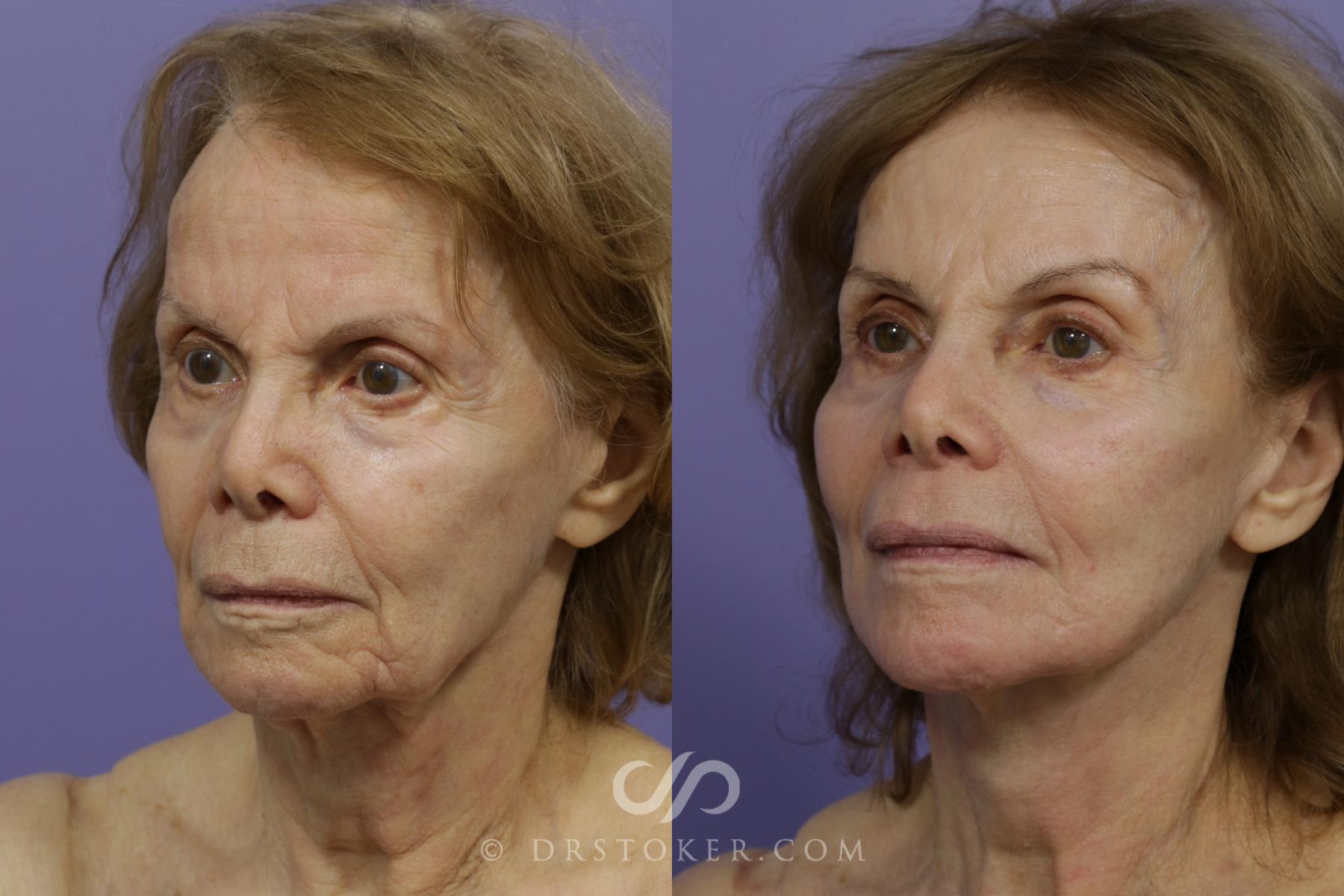 Before & After Laser Skin Resurfacing Case 1441 View #2 View in Los Angeles, CA