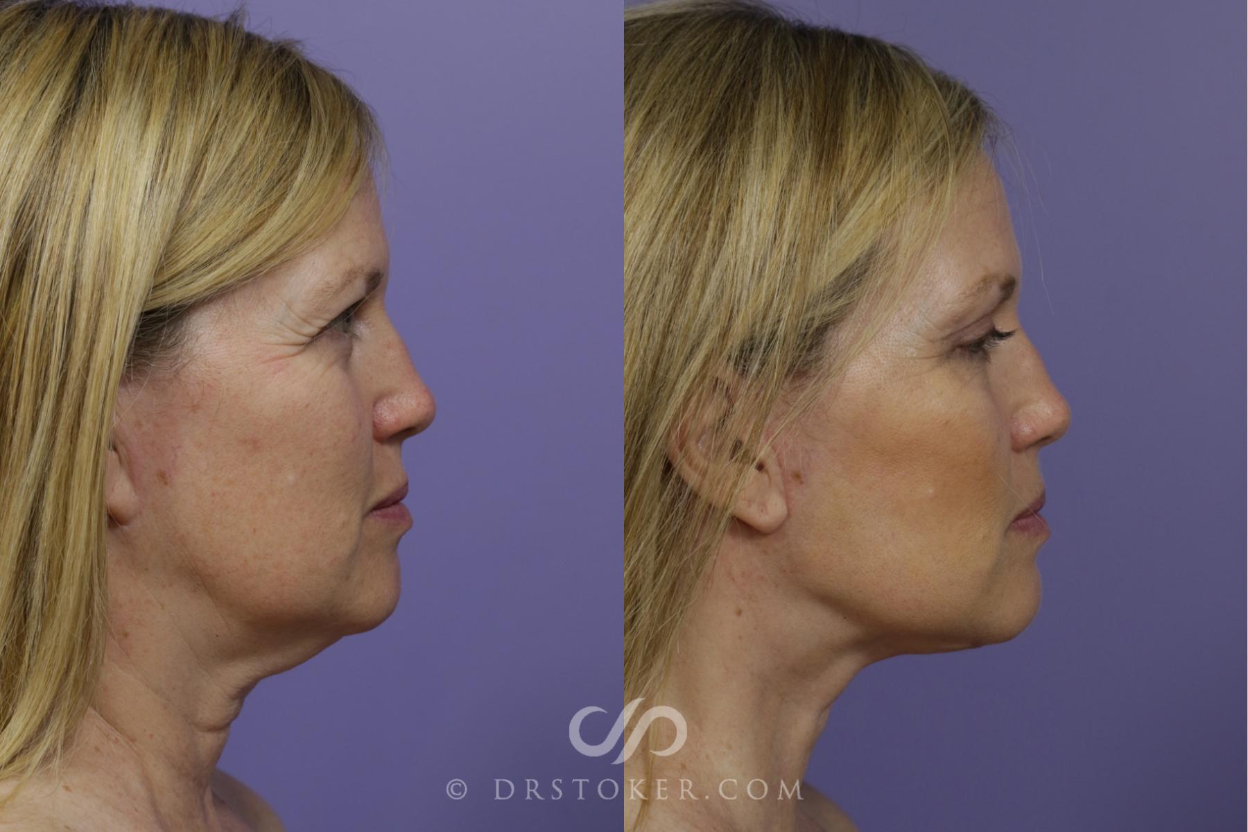 Before & After Laser Skin Resurfacing Case 1469 View #3 View in Los Angeles, CA