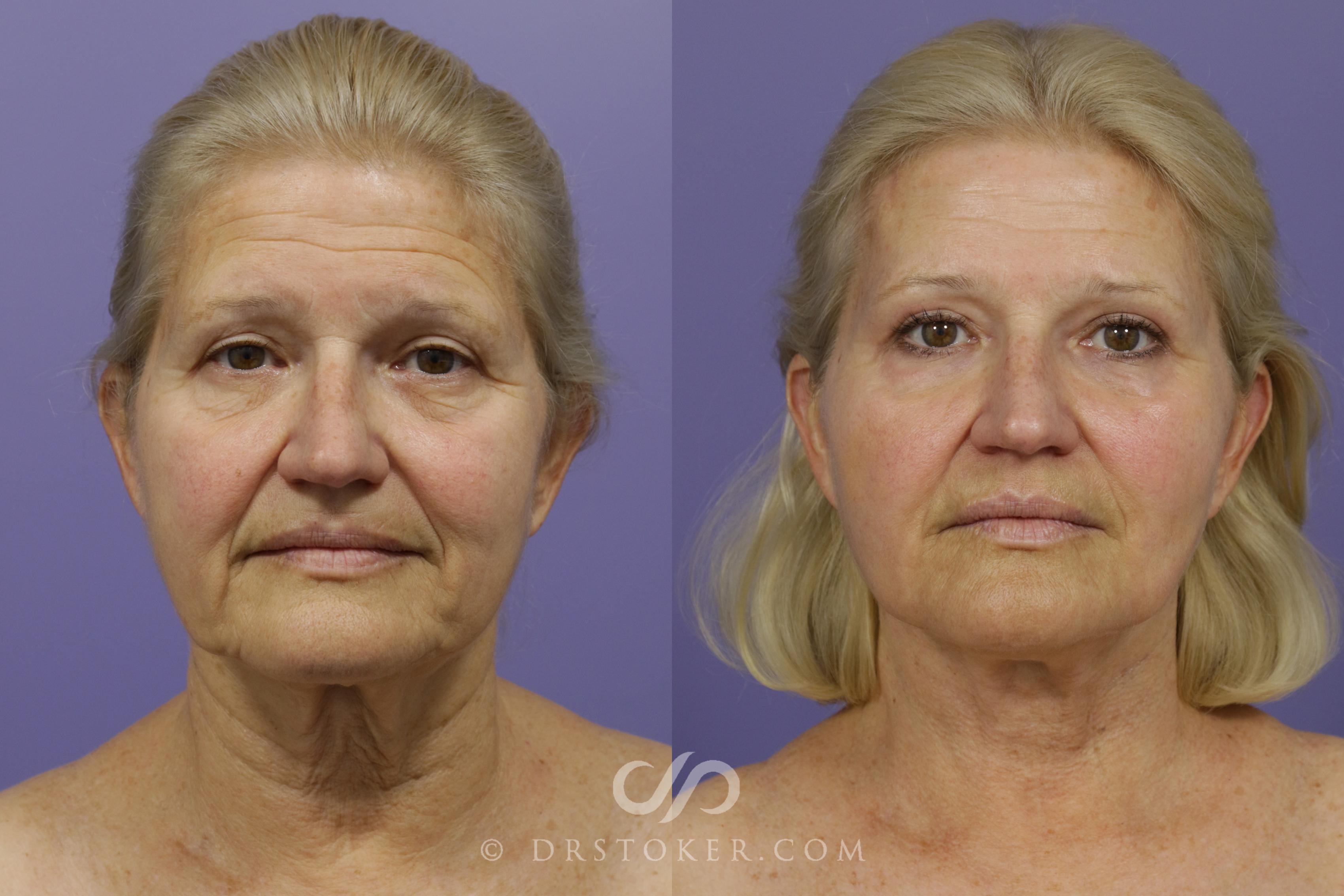 Before & After Laser Skin Resurfacing Case 1497 View #1 View in Los Angeles, CA