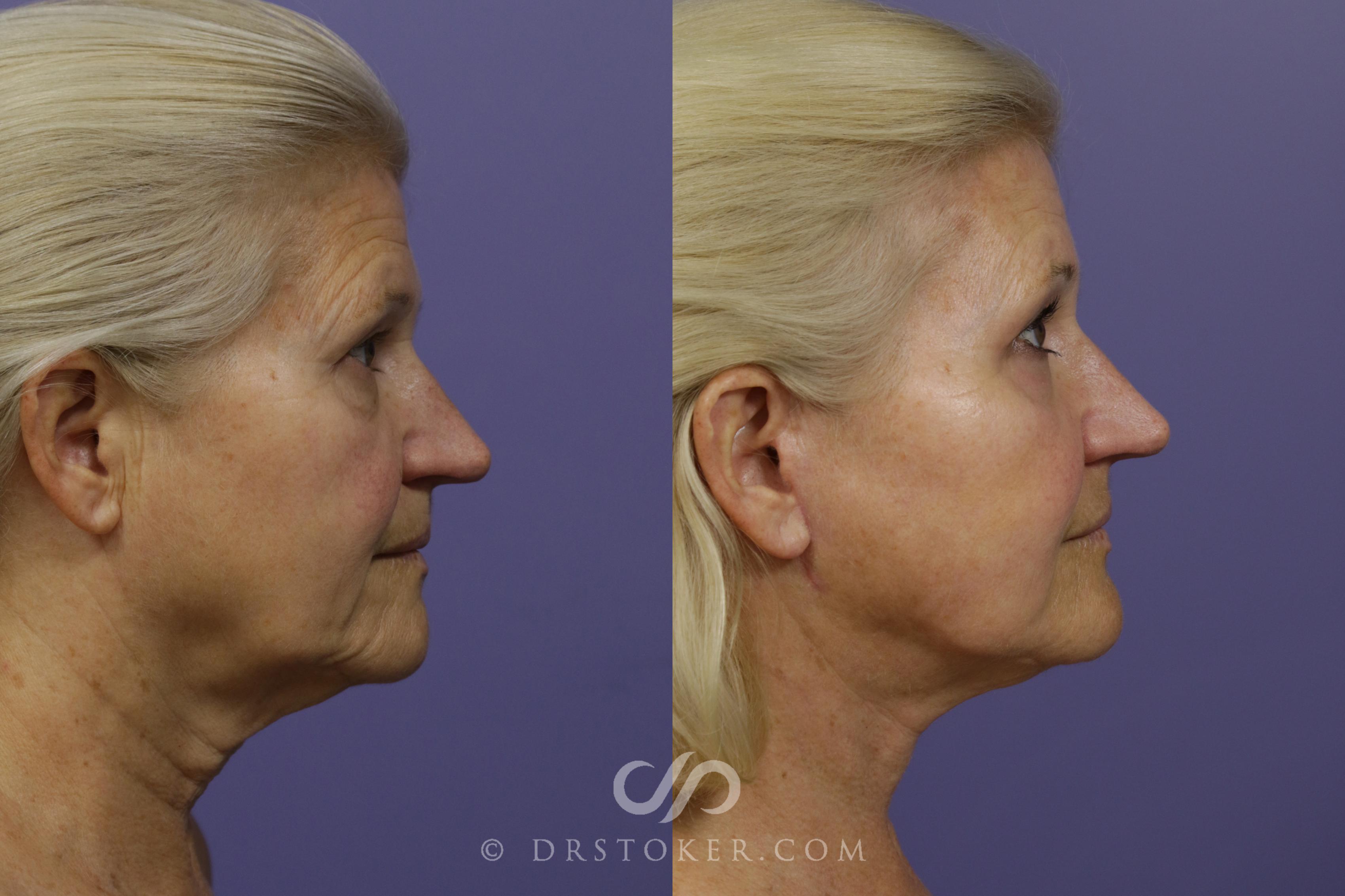 Before & After Laser Skin Resurfacing Case 1497 View #2 View in Los Angeles, CA