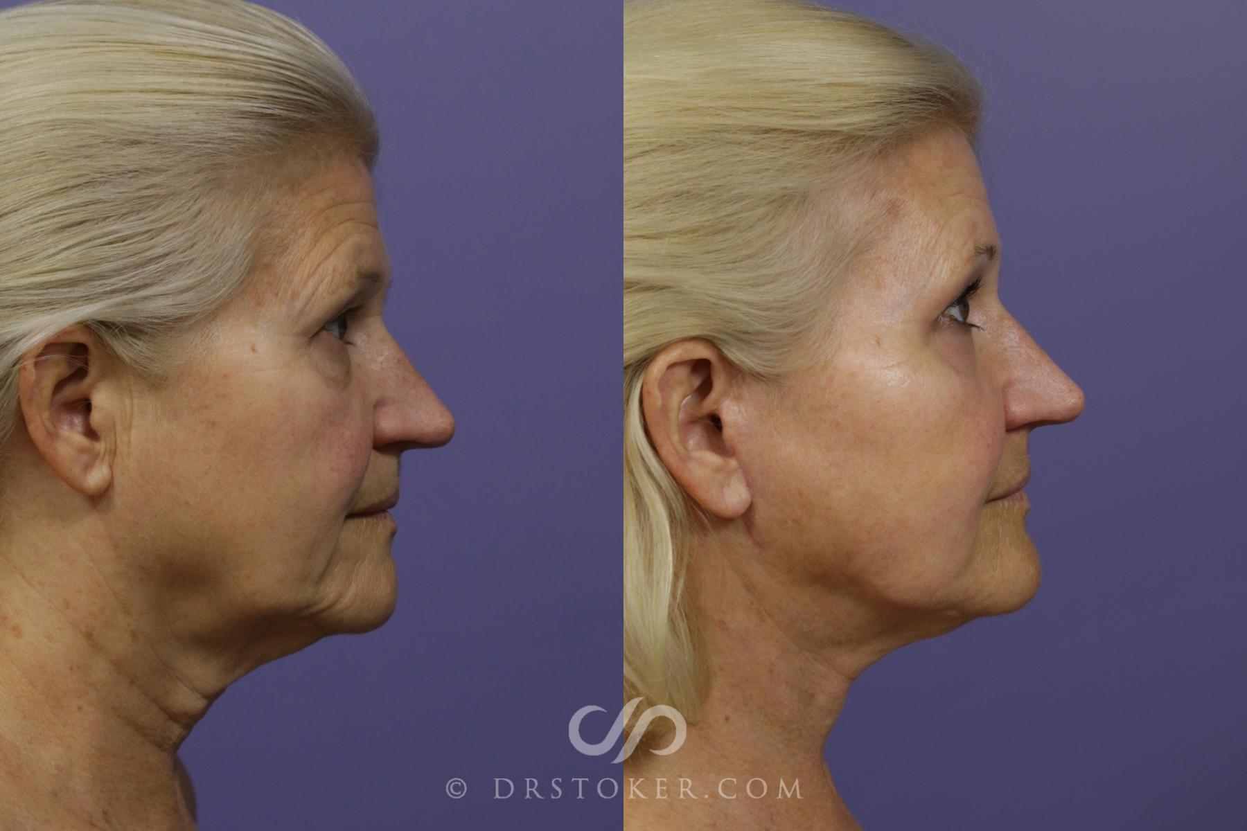 Before & After Neck Lift - Traceless Neck Lift  Case 1497 View #2 View in Los Angeles, CA