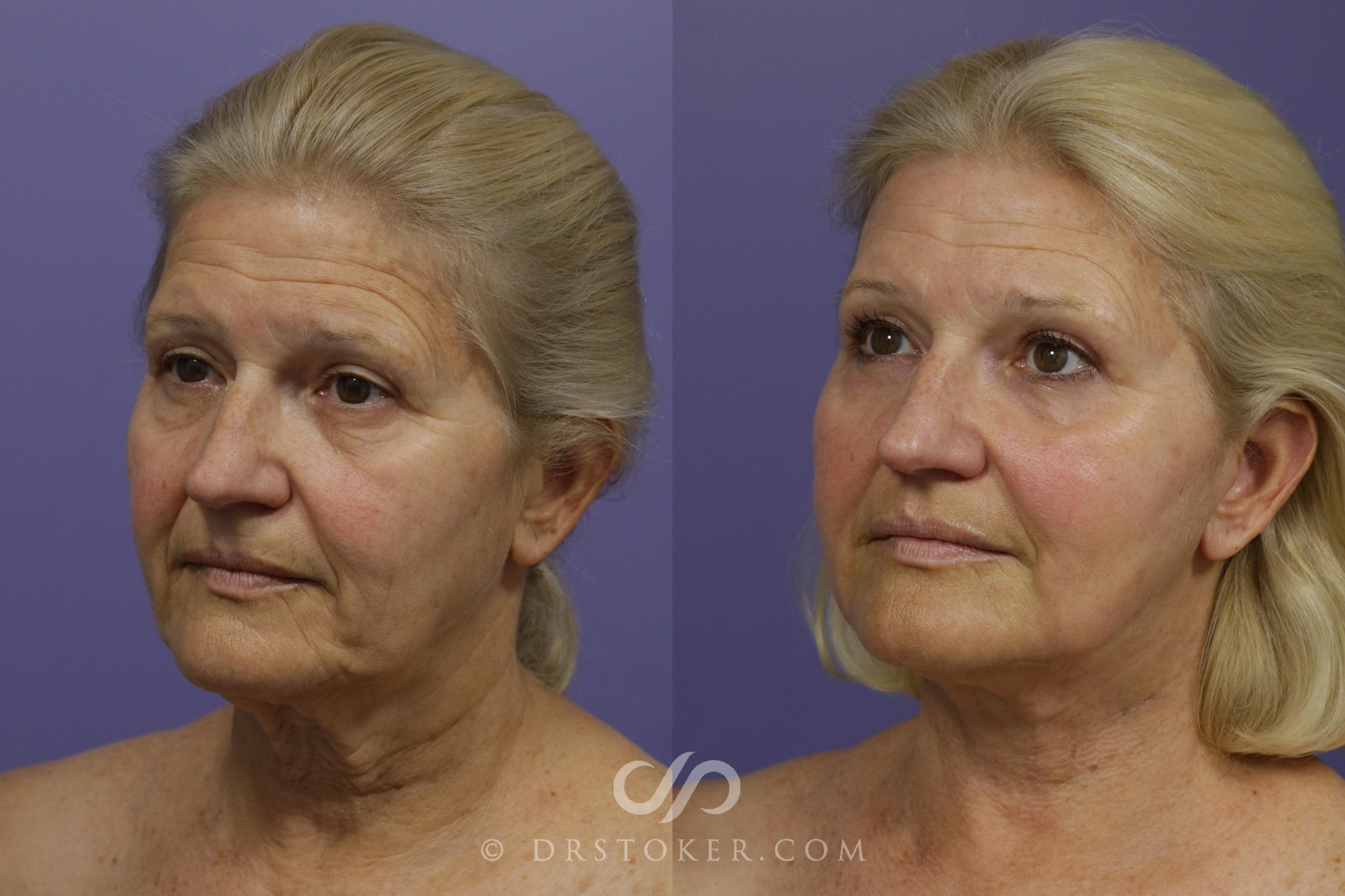 Before & After Laser Skin Resurfacing Case 1497 View #3 View in Los Angeles, CA