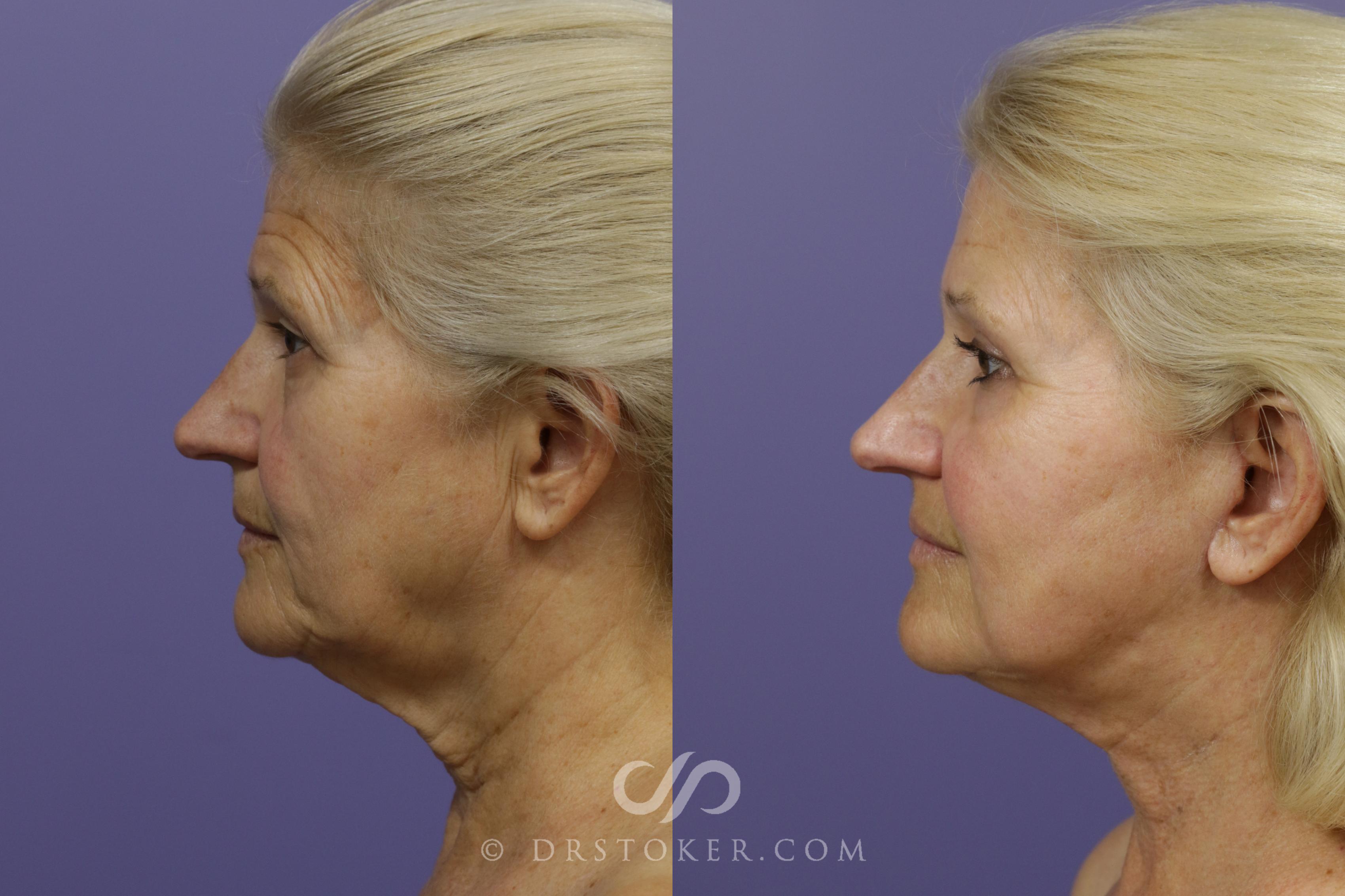 Before & After Laser Skin Resurfacing Case 1497 View #4 View in Los Angeles, CA