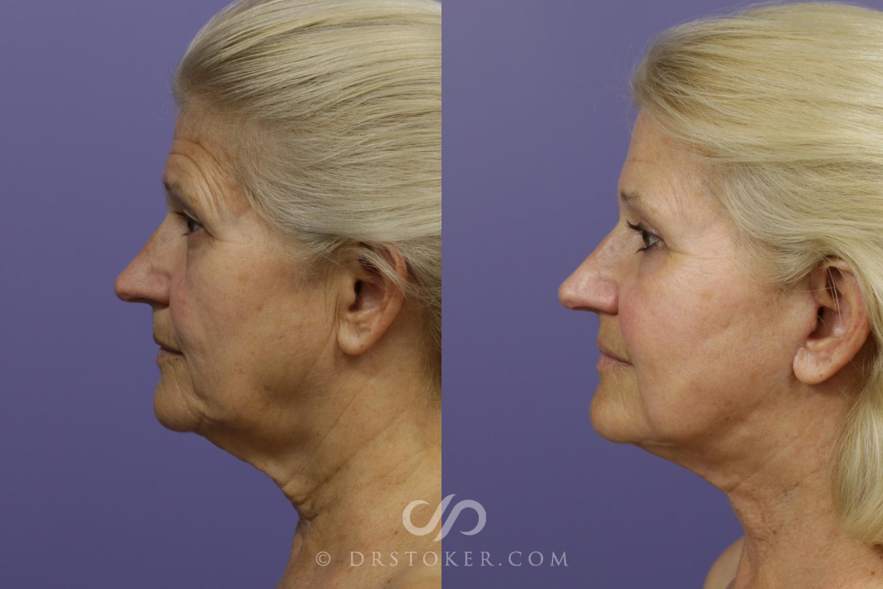Before & After Laser Skin Resurfacing  Case 1497 View #4 View in Los Angeles, CA