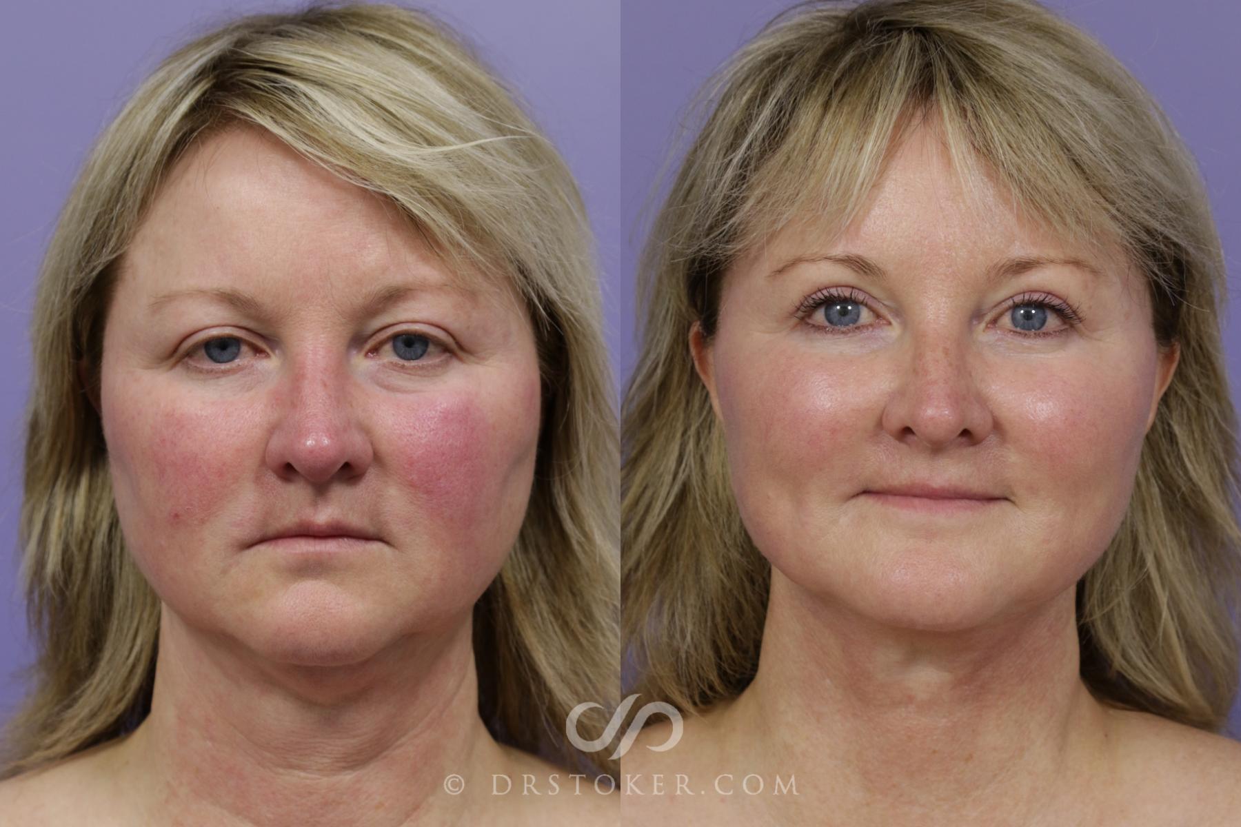 Before & After Cheek/Chin Contouring Case 1530 View #1 View in Los Angeles, CA