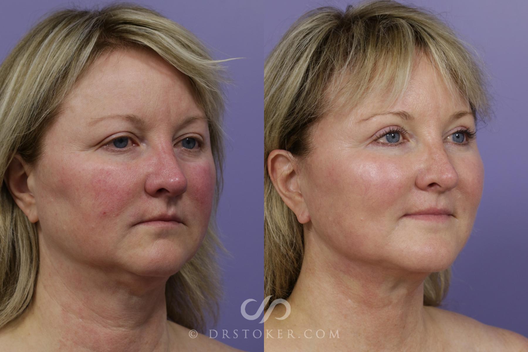 Before & After Facelift - Traceless Facelift Case 1530 View #2 View in Los Angeles, CA
