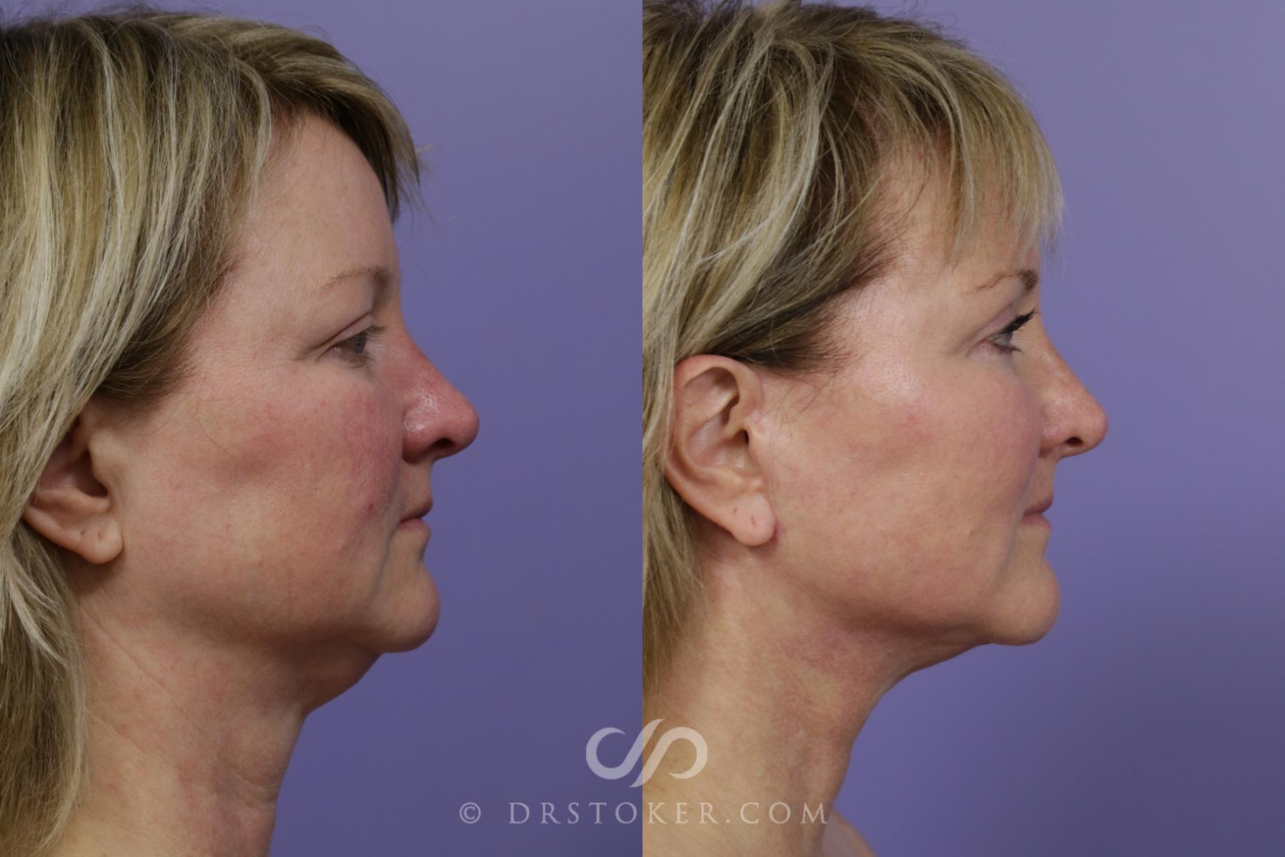 Before & After Facelift - Traceless Facelift Case 1530 View #3 View in Los Angeles, CA