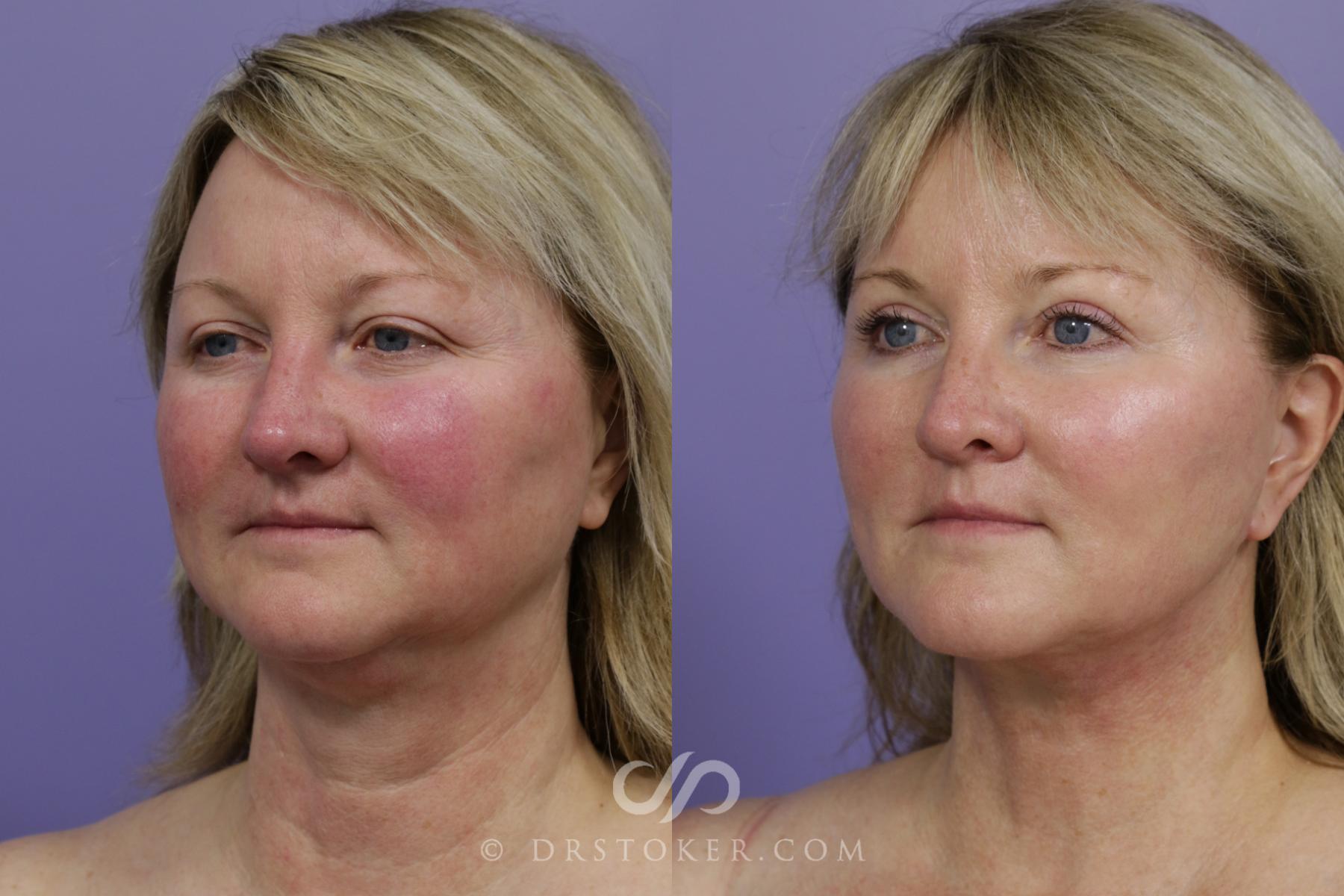 Before & After Facelift - Traceless Facelift Case 1530 View #4 View in Los Angeles, CA