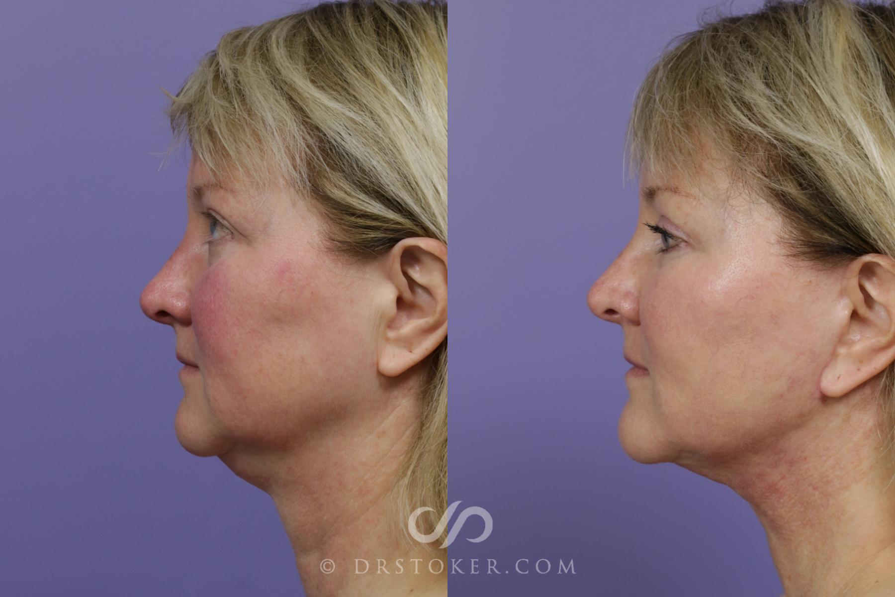 Before & After Cheek/Chin Contouring Case 1530 View #5 View in Los Angeles, CA
