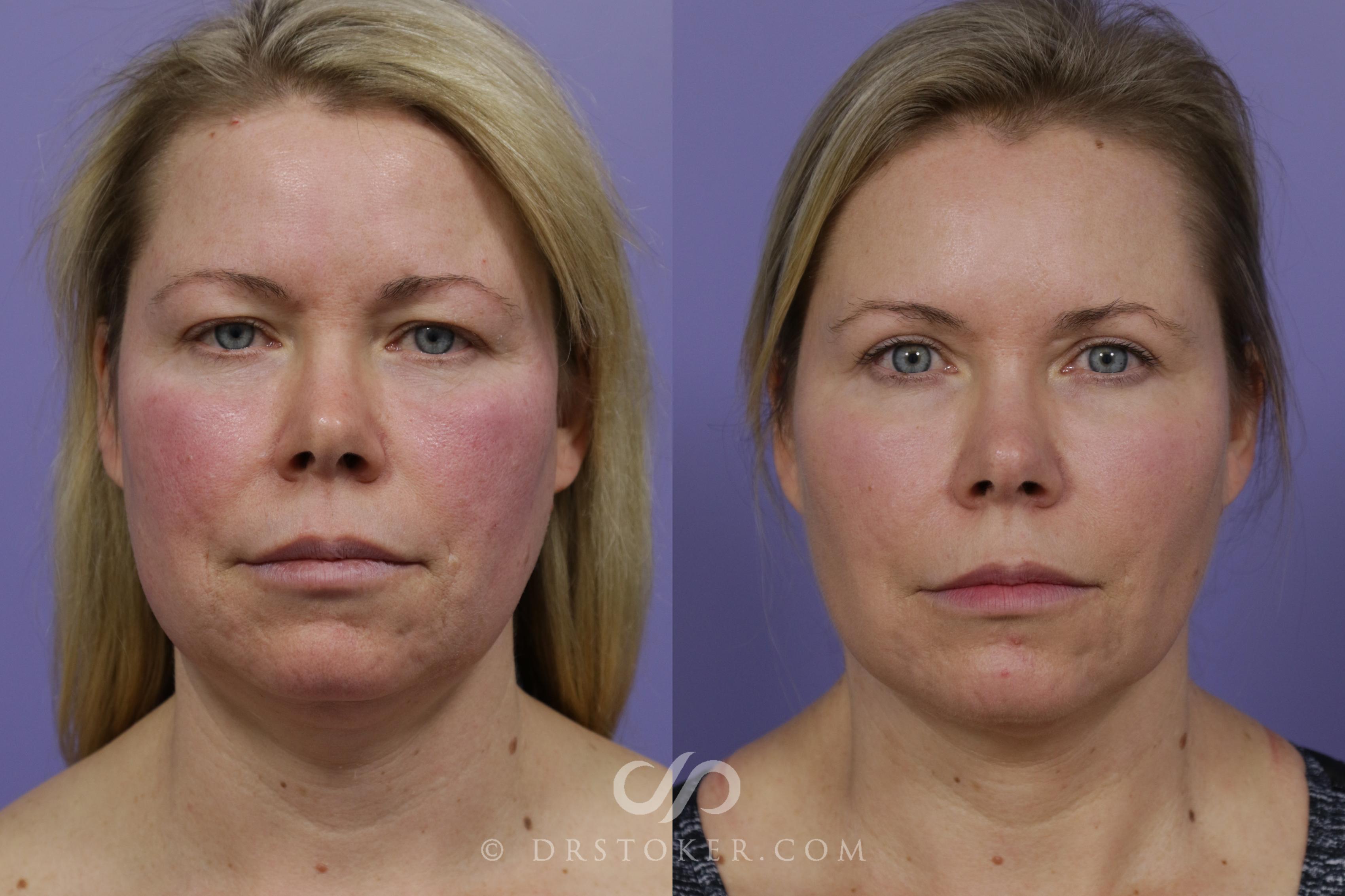 Before & After Buccal Fat Reduction Case 1531 View #1 View in Los Angeles, CA