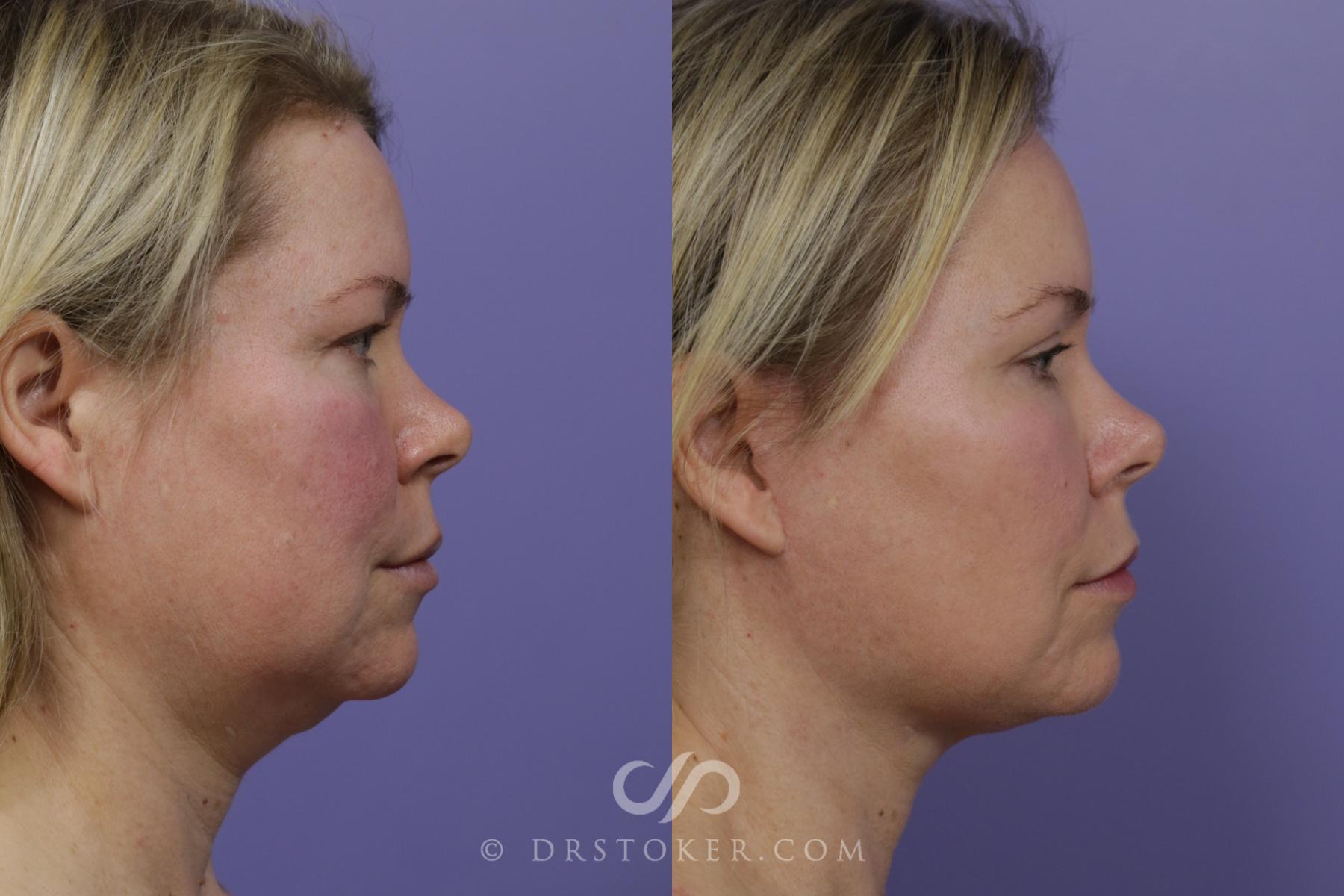 Before & After Buccal Fat Reduction Case 1531 View #2 View in Los Angeles, CA