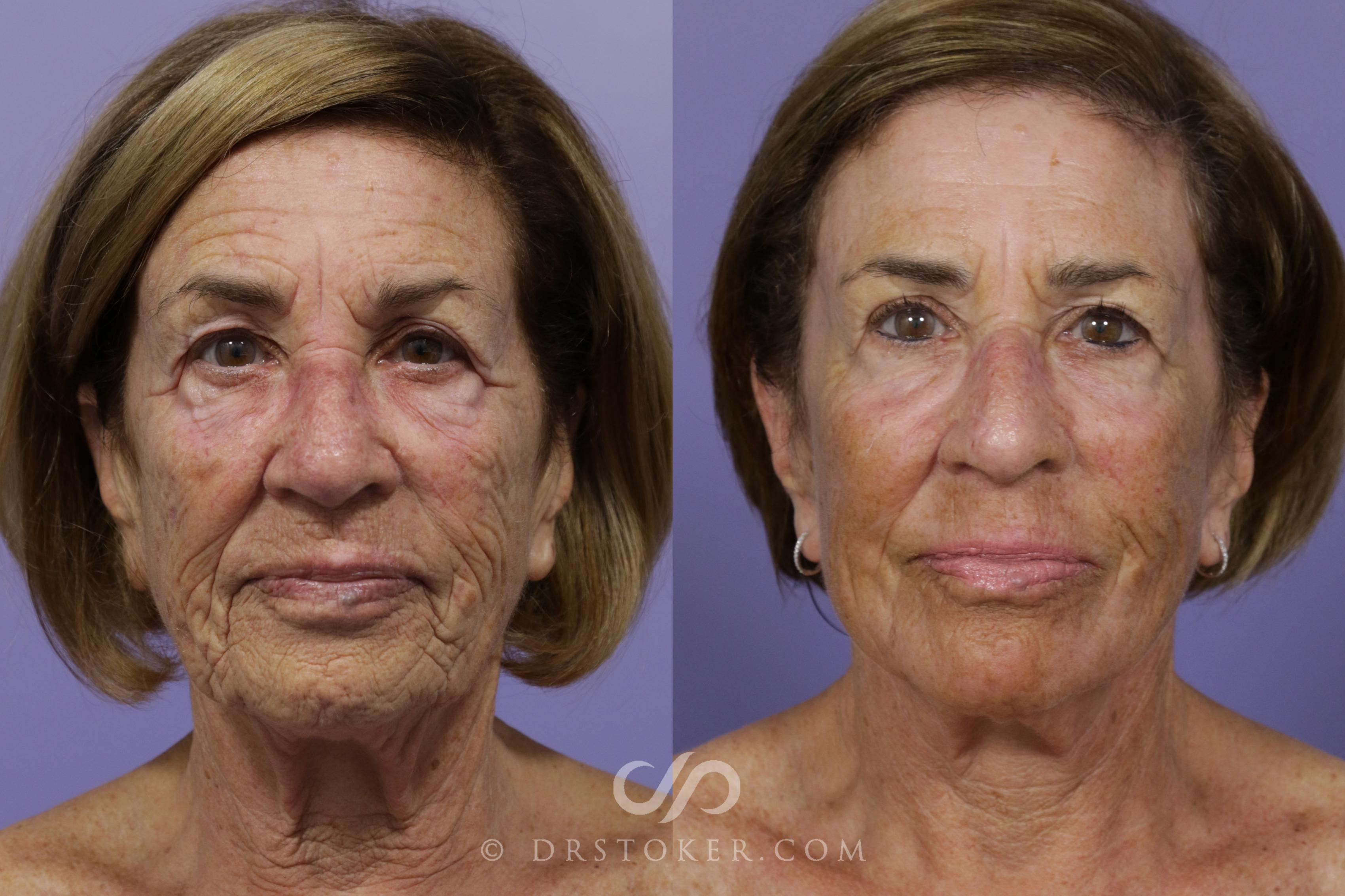 Before & After Facelift - Traceless Facelift Case 1535 View #1 View in Los Angeles, CA