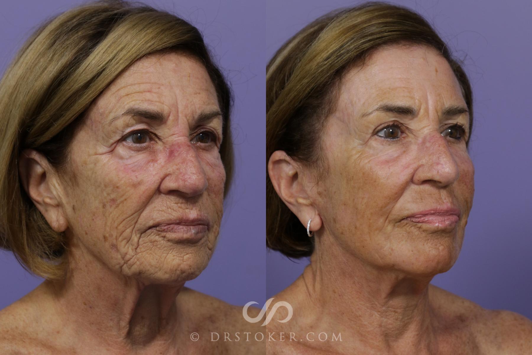 Before & After Facelift - Traceless Facelift Case 1535 View #2 View in Los Angeles, CA