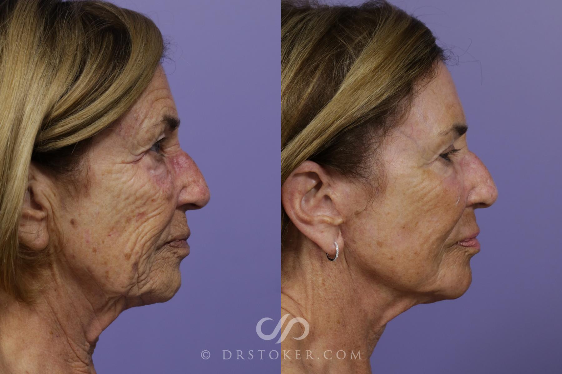 Before & After Laser Skin Resurfacing Case 1535 View #3 View in Los Angeles, CA