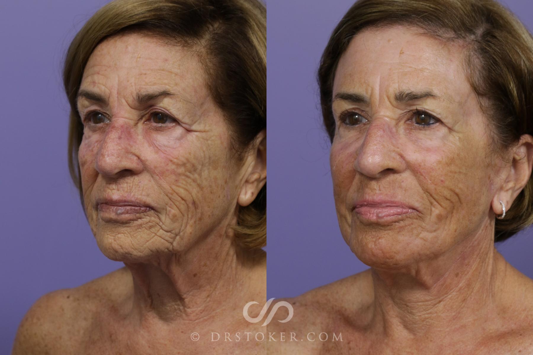 Before & After Facelift - Traceless Facelift Case 1535 View #4 View in Los Angeles, CA