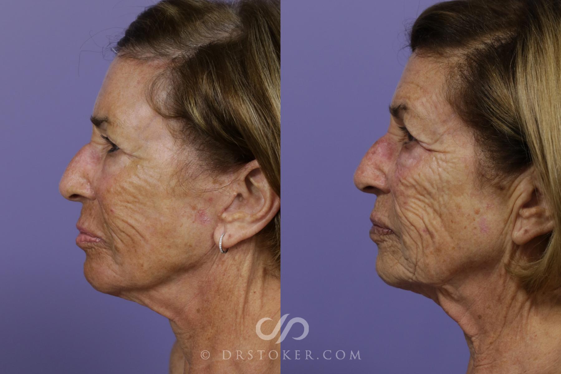 Before & After Laser Skin Resurfacing  Case 1535 View #5 View in Los Angeles, CA