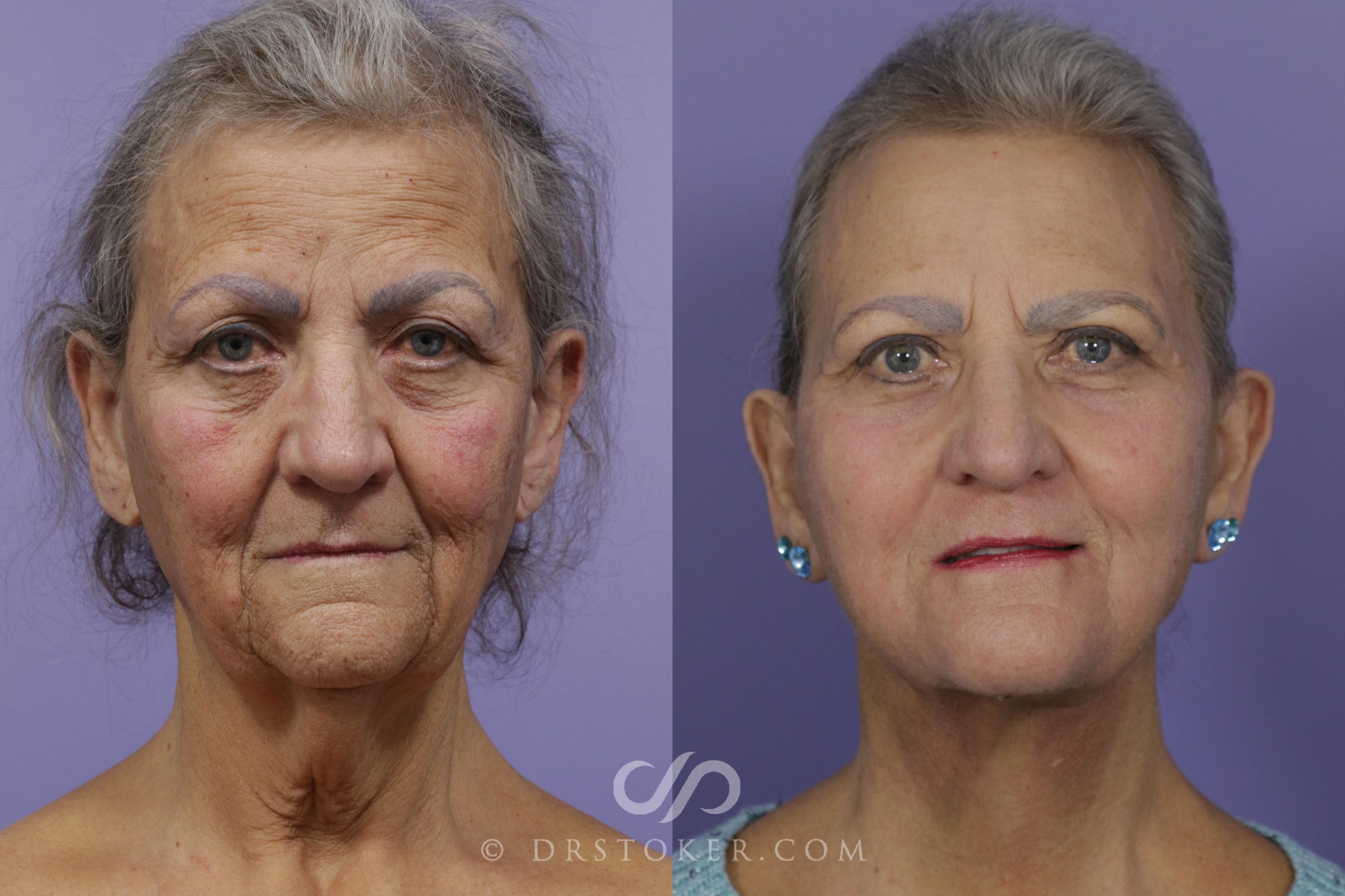 Before & After Facelift - Traceless Facelift Case 1674 View #1 View in Los Angeles, CA