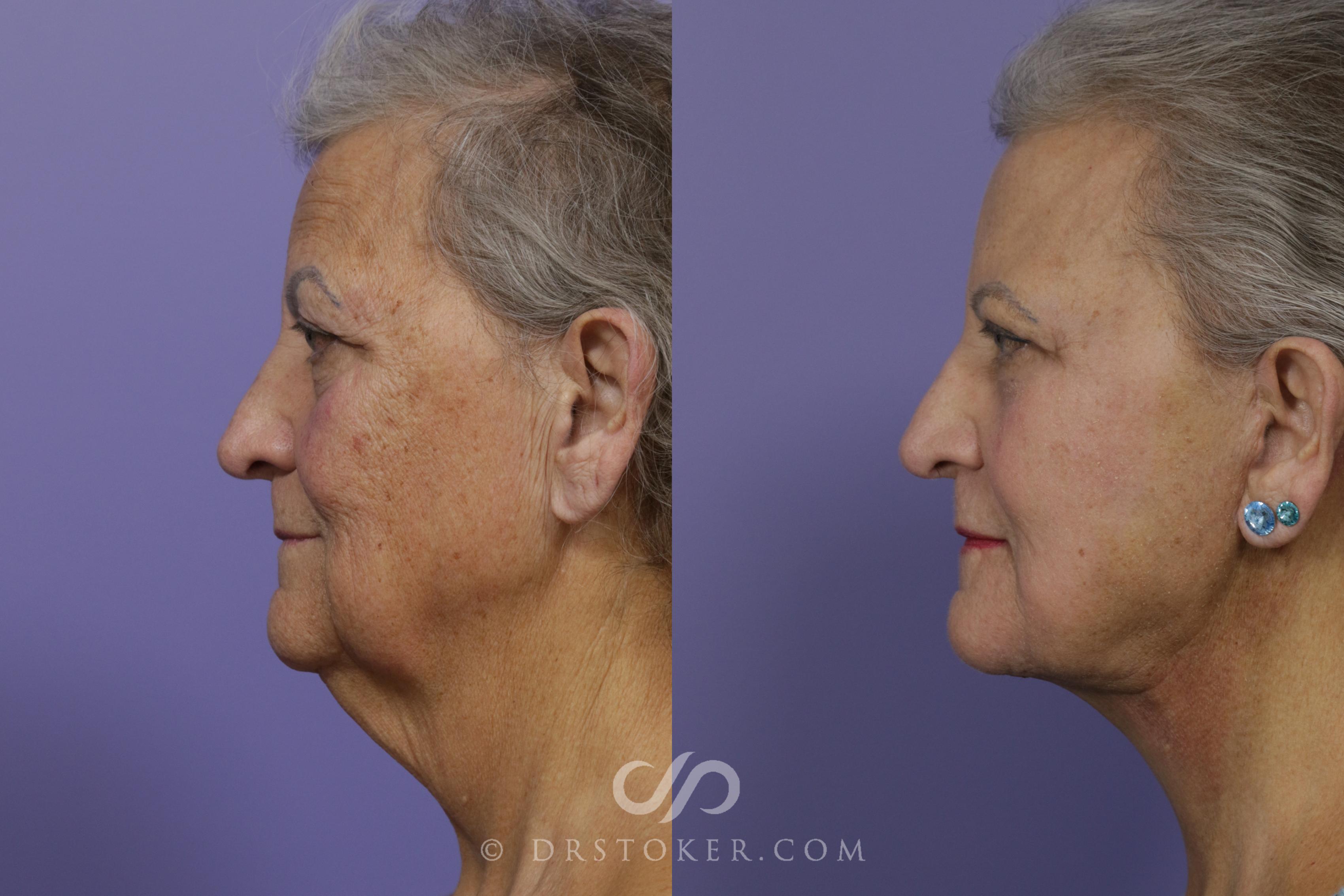 Before & After Facelift - Traceless Facelift Case 1675 View #1 View in Los Angeles, CA