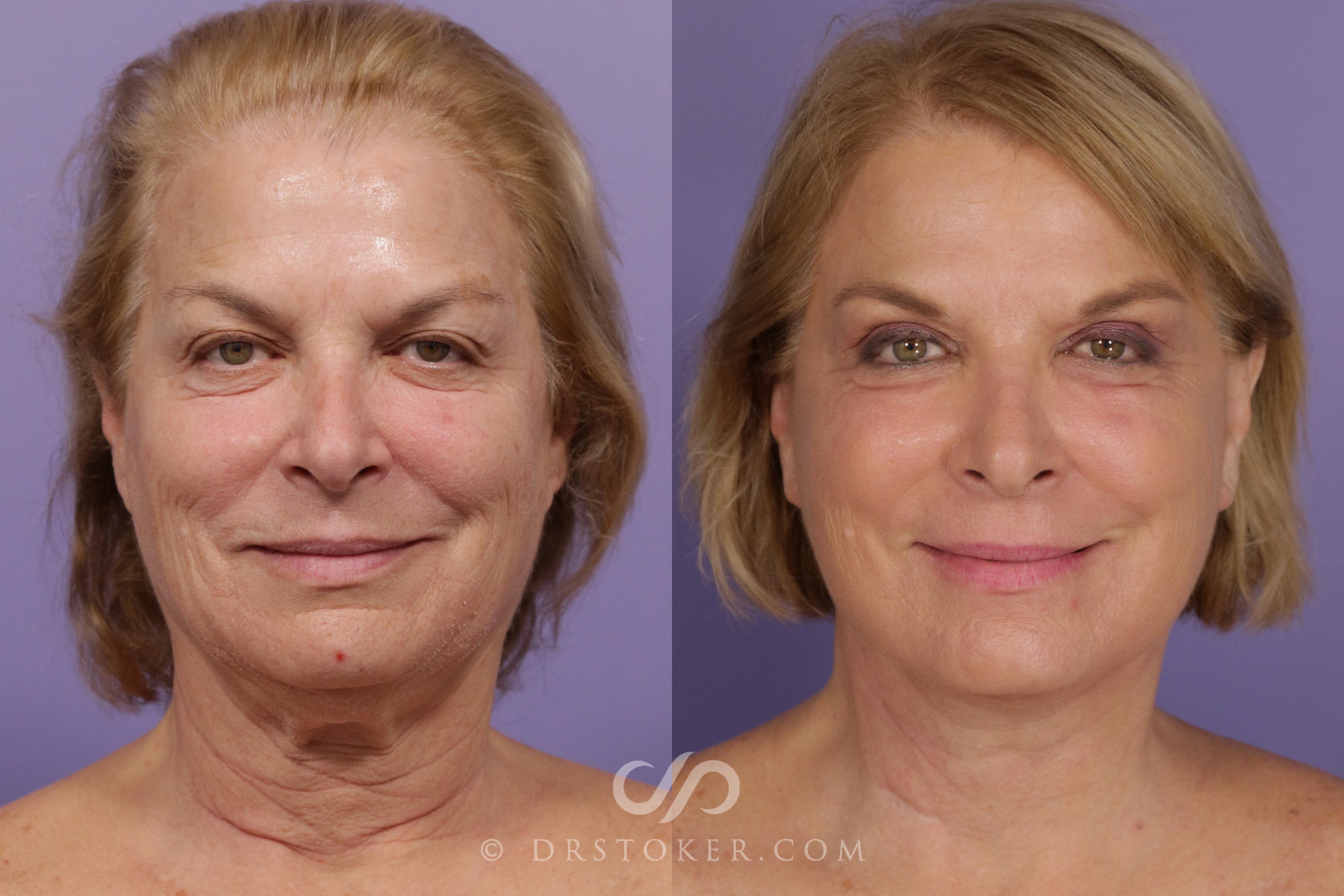 Before & After Neck Lift - Traceless Neck Lift  Case 1735 View #1 View in Los Angeles, CA