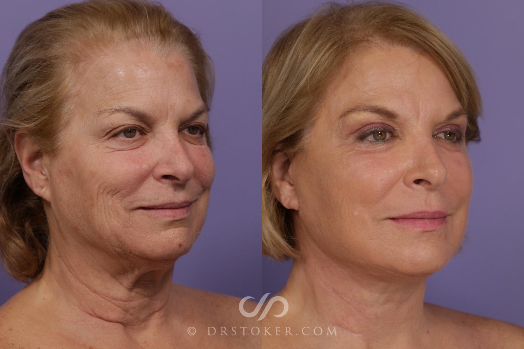 Before & After Facelift - Traceless Facelift Case 1735 View #2 View in Los Angeles, CA