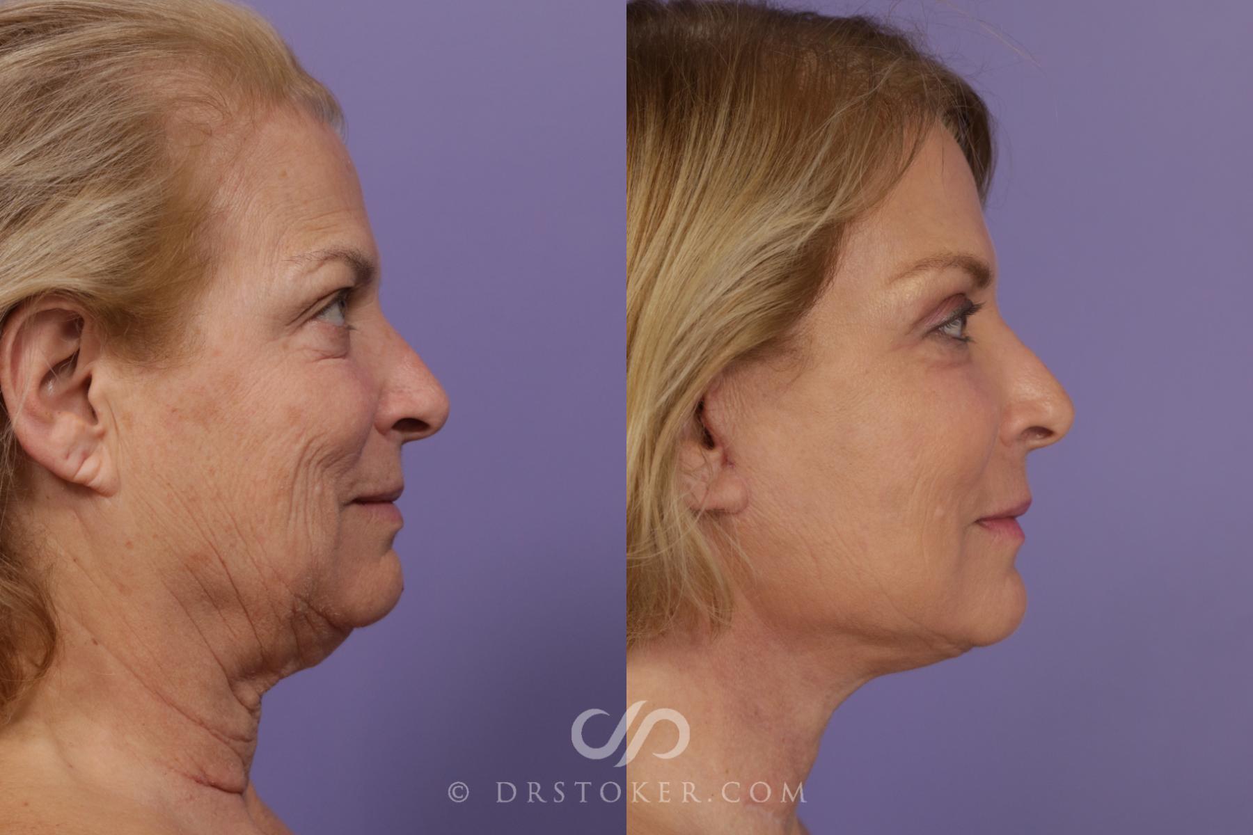 Before & After Neck Lift - Traceless Neck Lift  Case 1735 View #3 View in Los Angeles, CA