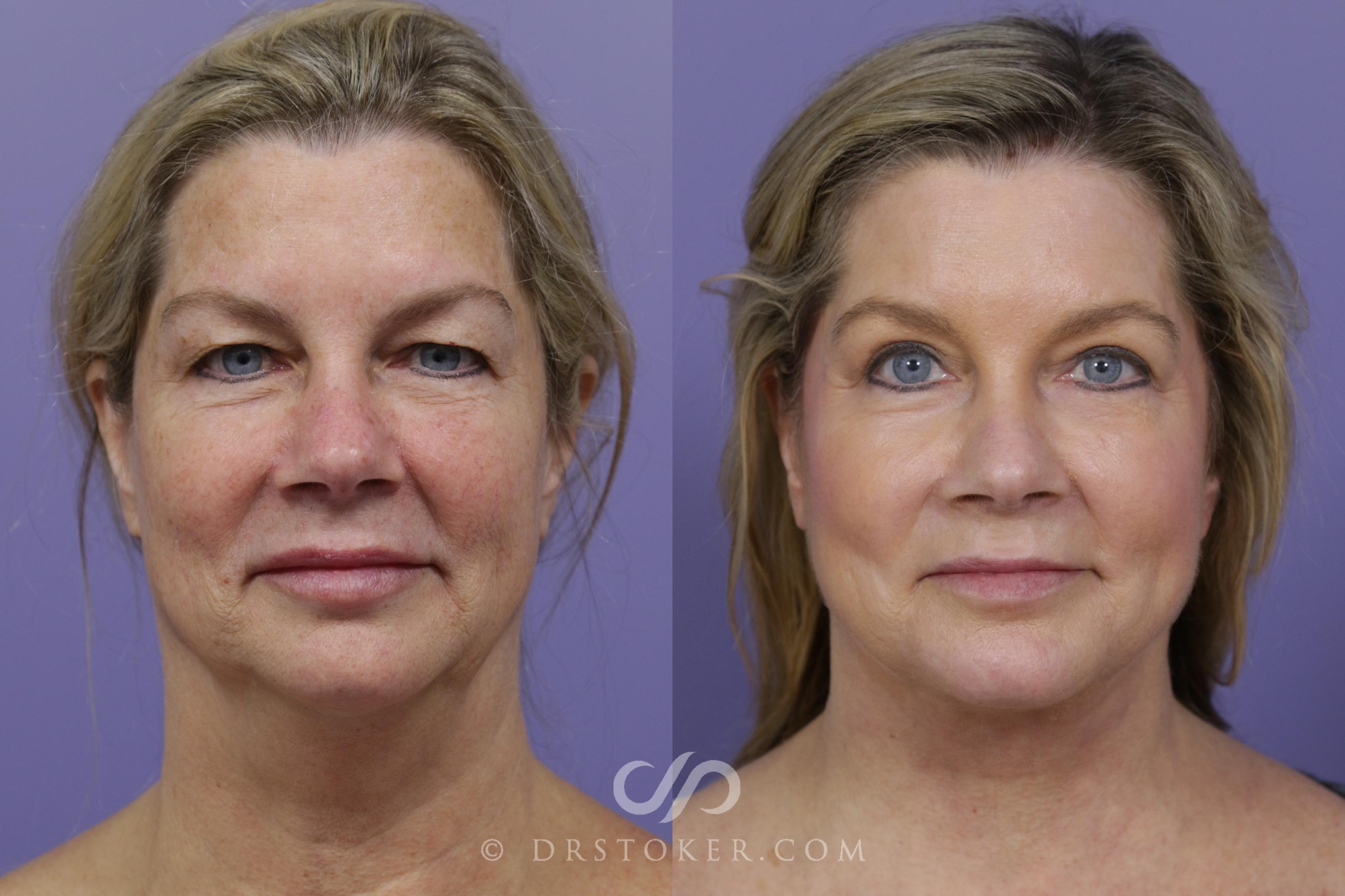 Before & After Neck Lift - Traceless Neck Lift  Case 1766 View #1 View in Los Angeles, CA