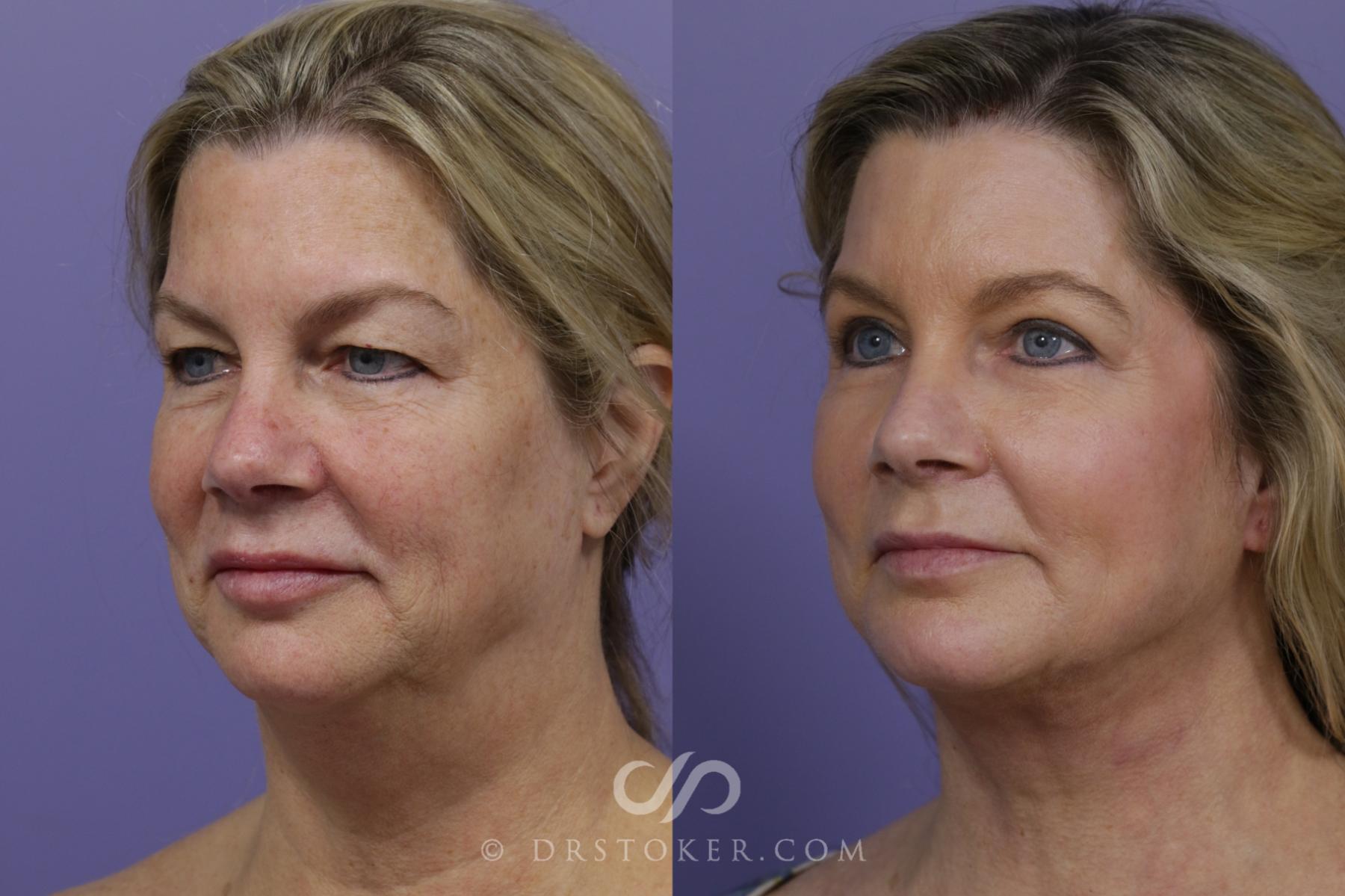 Before & After Neck Lift - Traceless Neck Lift  Case 1766 View #2 View in Los Angeles, CA
