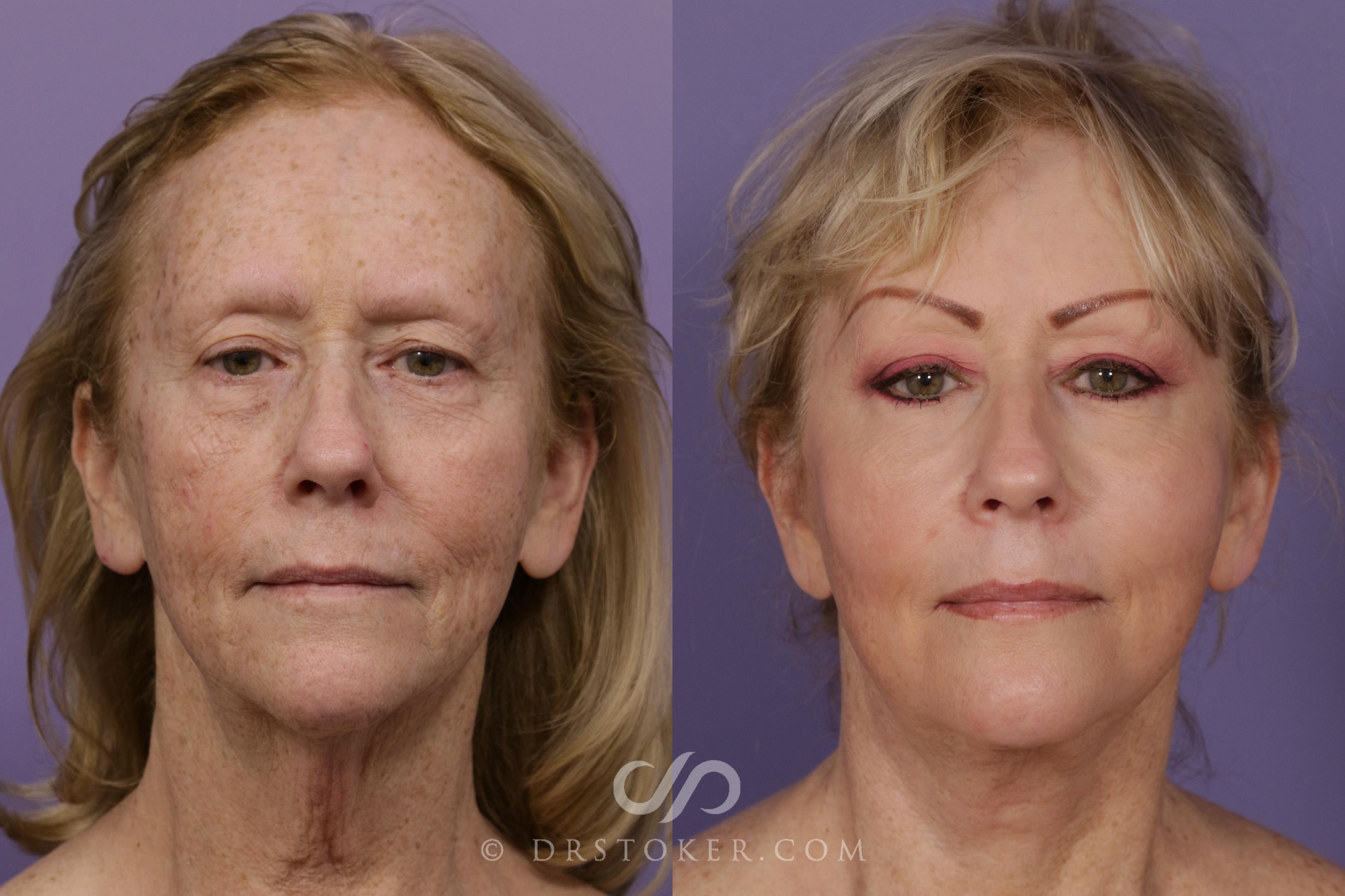 Before & After Facelift - Traceless Facelift Case 1767 View #1 View in Los Angeles, CA