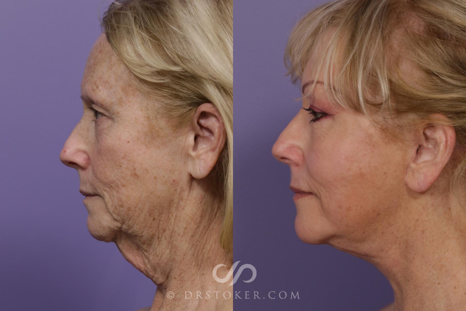 Before & After Facelift - Traceless Facelift Case 1767 View #2 View in Los Angeles, CA