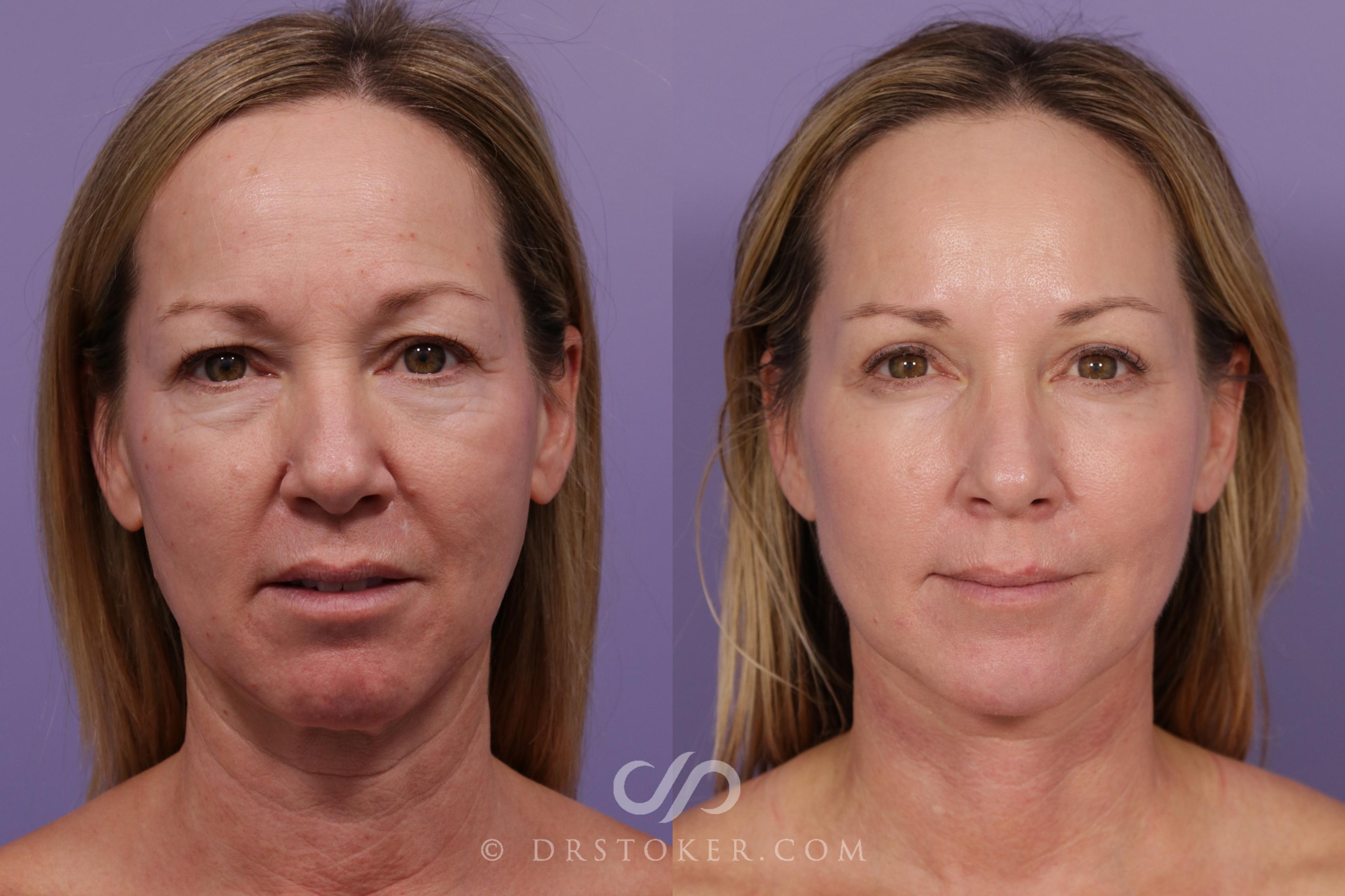 Before & After Facelift - Traceless Facelift Case 1768 View #1 View in Los Angeles, CA