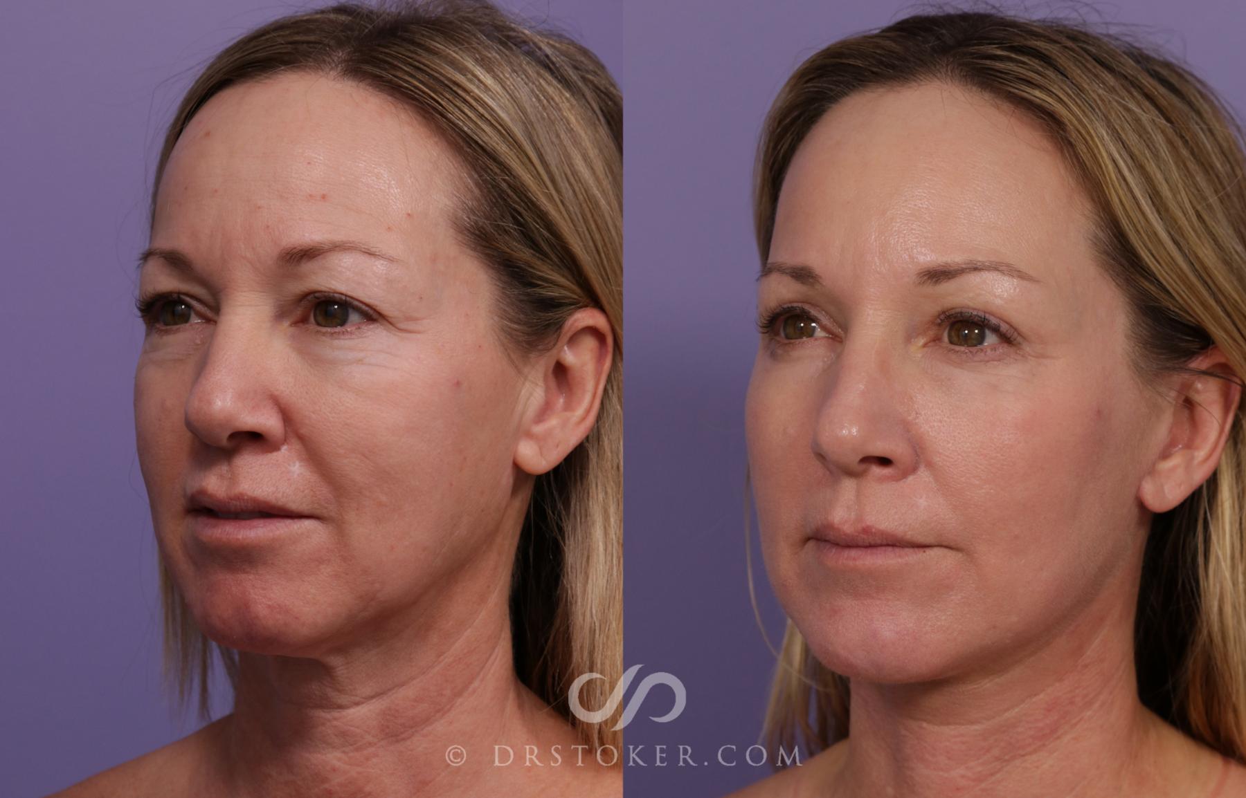 Before & After Facelift - Traceless Facelift Case 1768 View #2 View in Los Angeles, CA