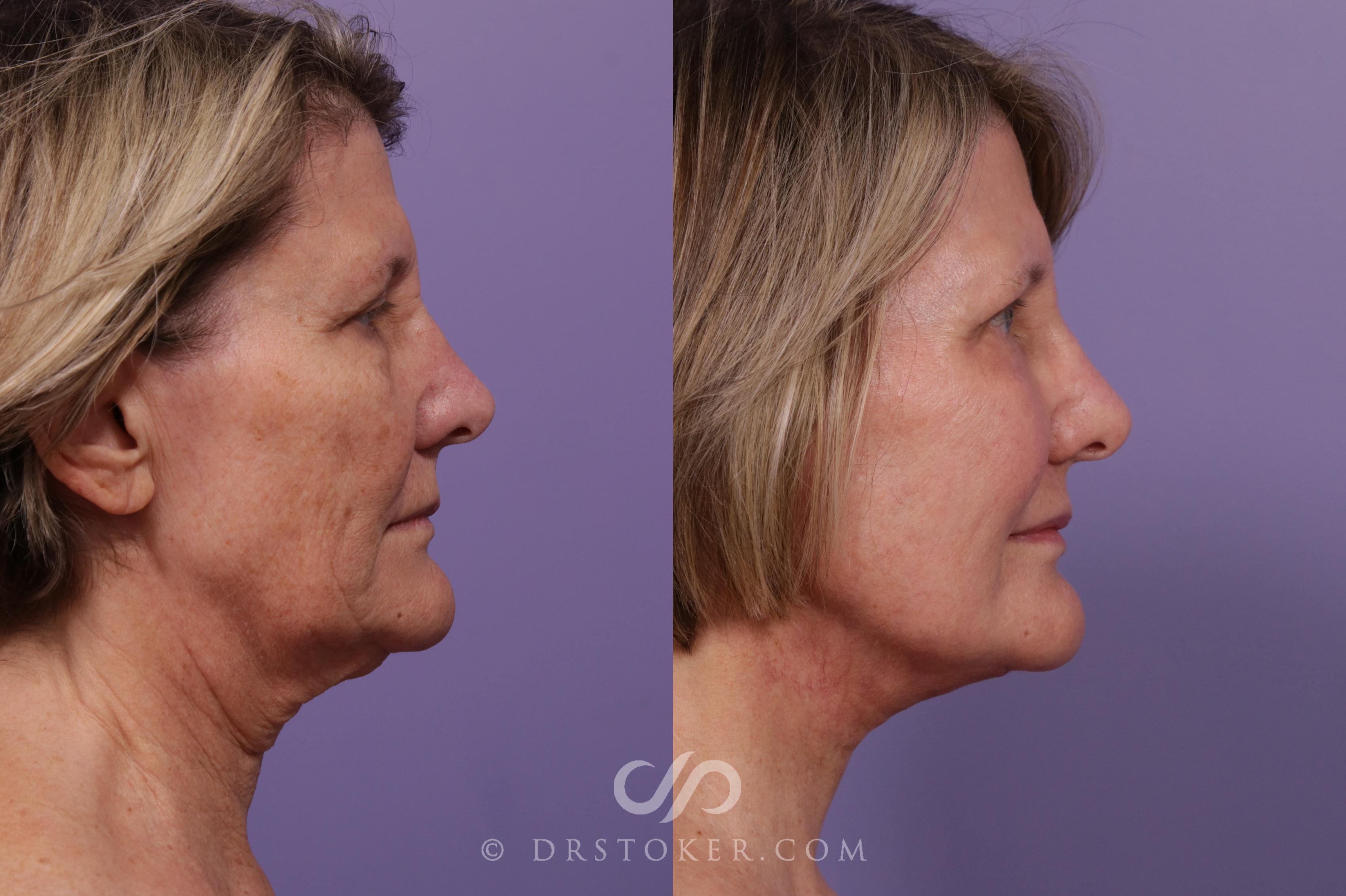 Before & After Facelift - Traceless Facelift Case 1769 Left Side View in Los Angeles, CA