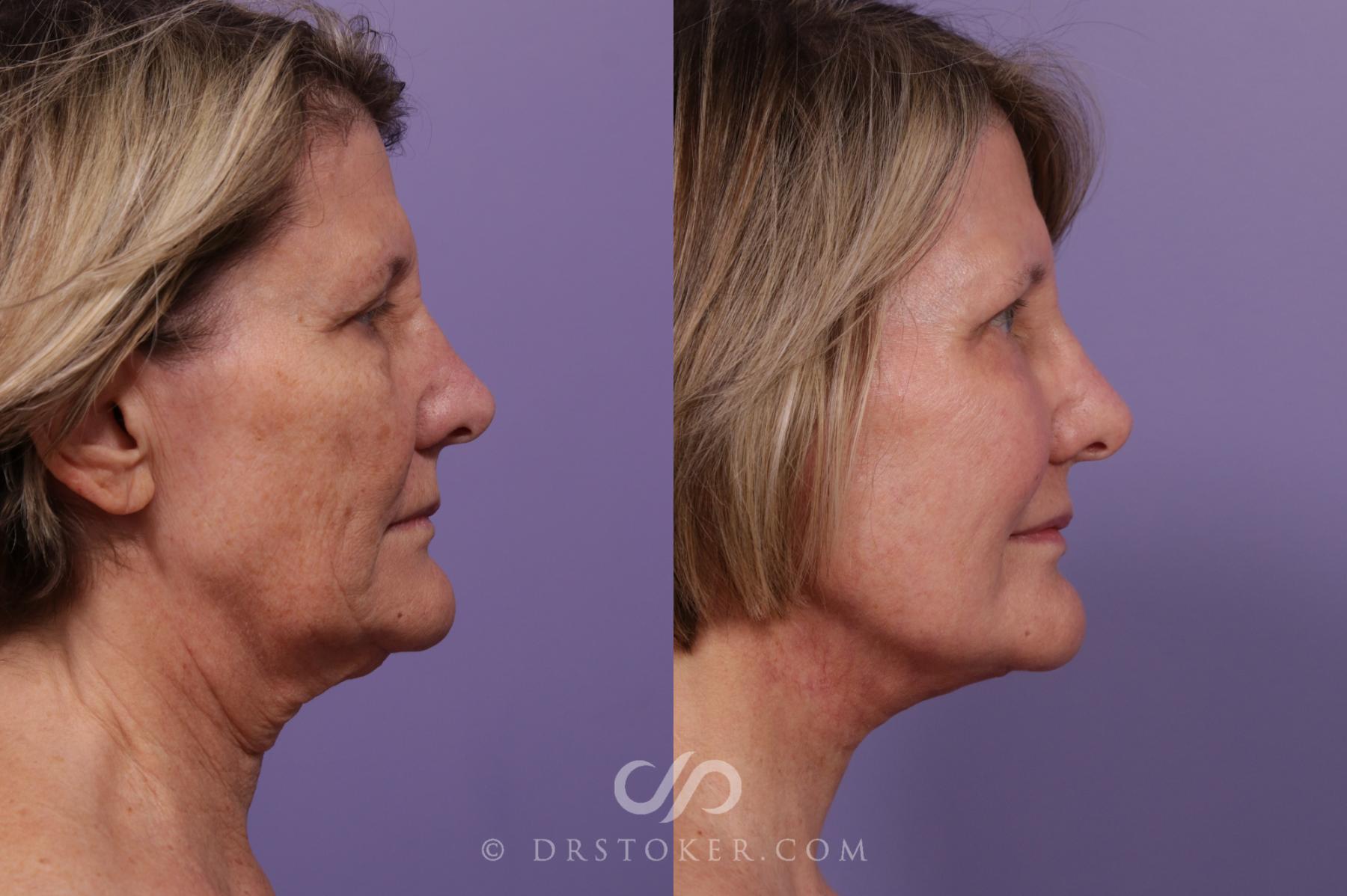 Before & After Facelift - Traceless Facelift Case 1769 Left Side View in Los Angeles, CA