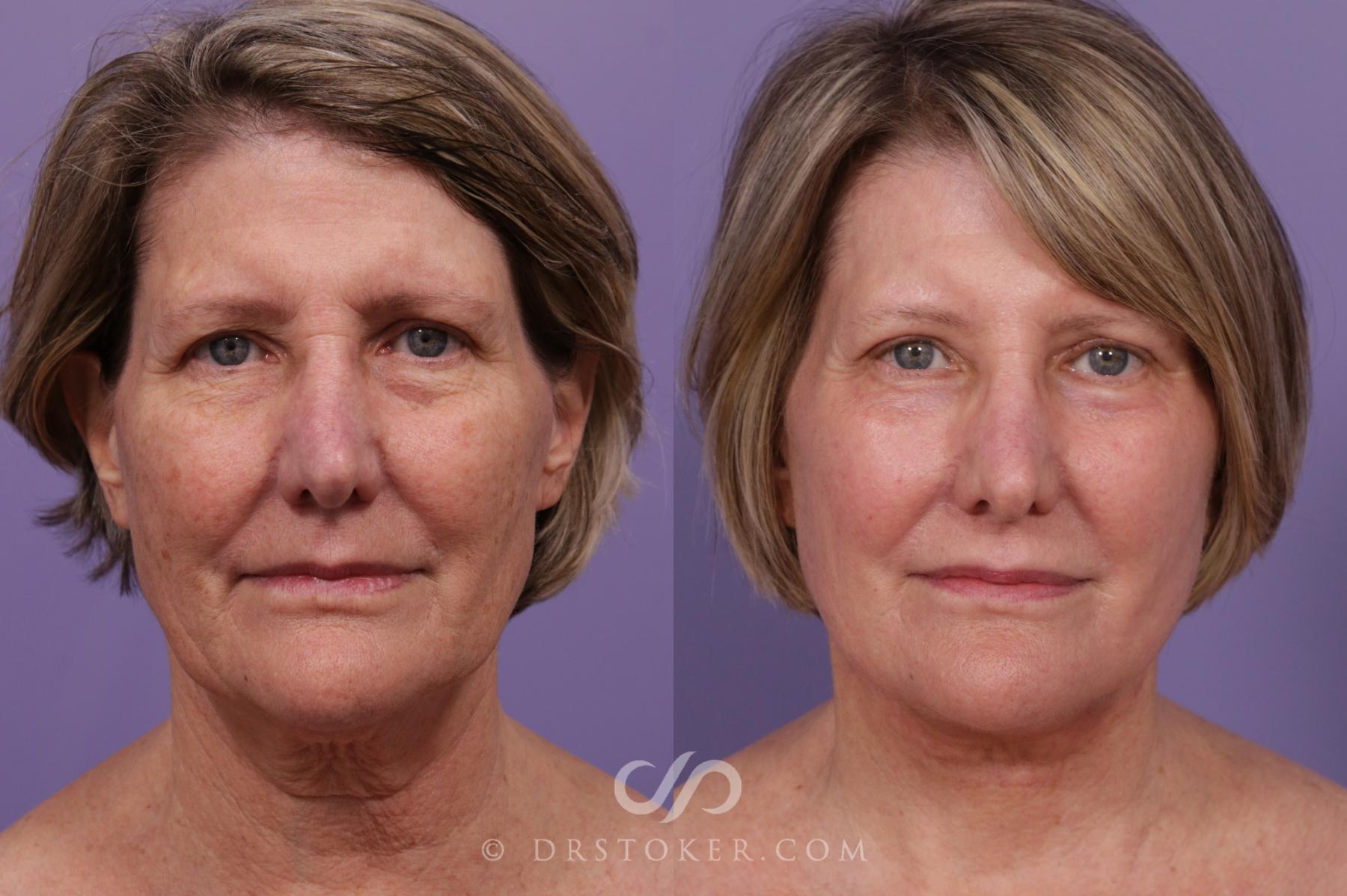Before & After Facelift - Traceless Facelift Case 1769 View #1 View in Los Angeles, CA