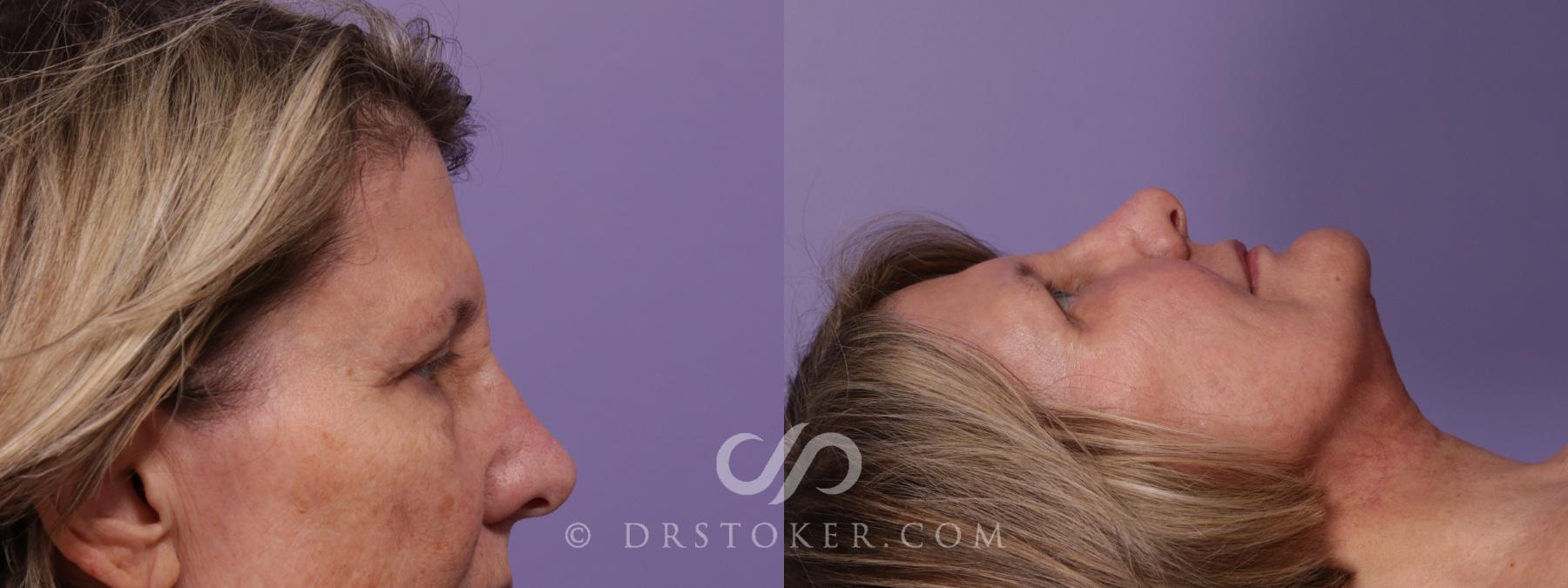 Before & After Facelift - Traceless Facelift Case 1769 View #2 View in Los Angeles, CA